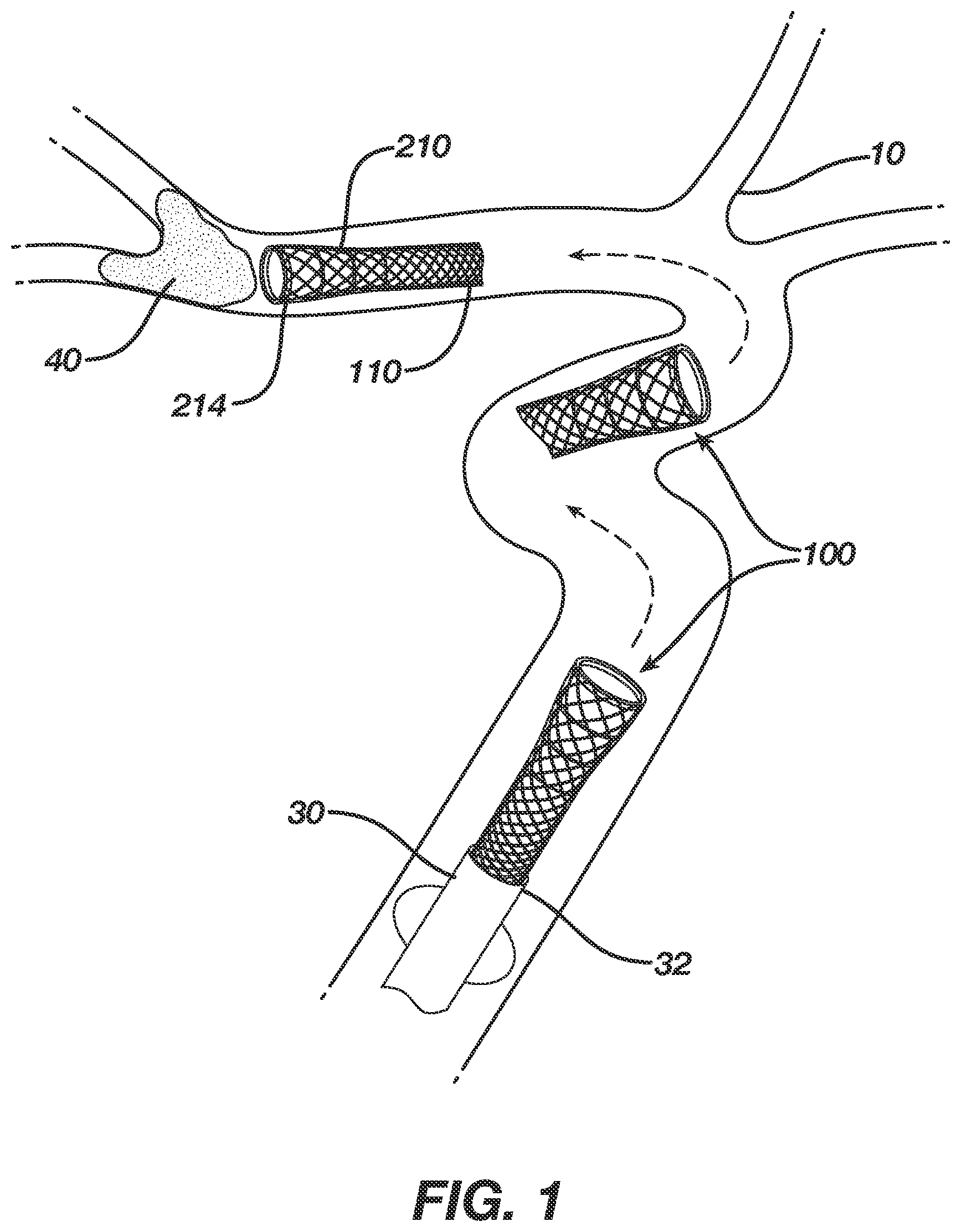Patent US12496080 Figure 1 – Super-bore catheter with braid supported flared tip