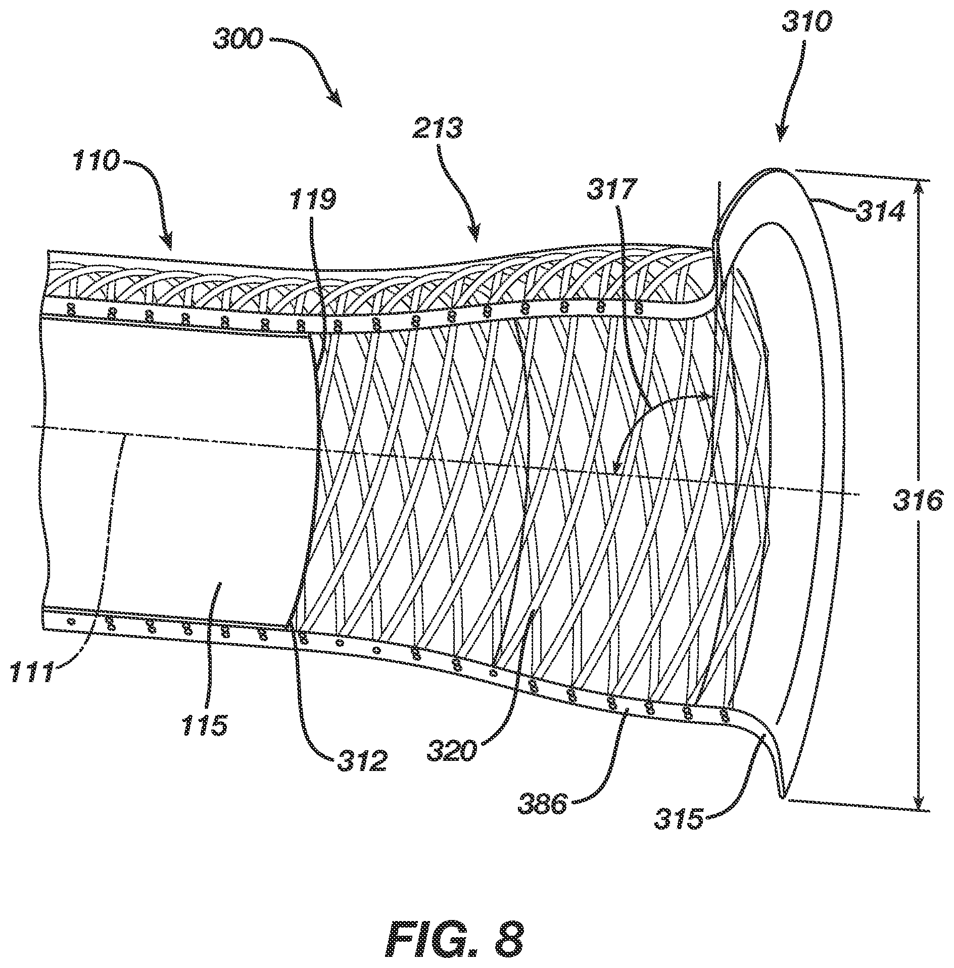 Patent US12496080 Figure 8 – Super-bore catheter with braid supported flared tip