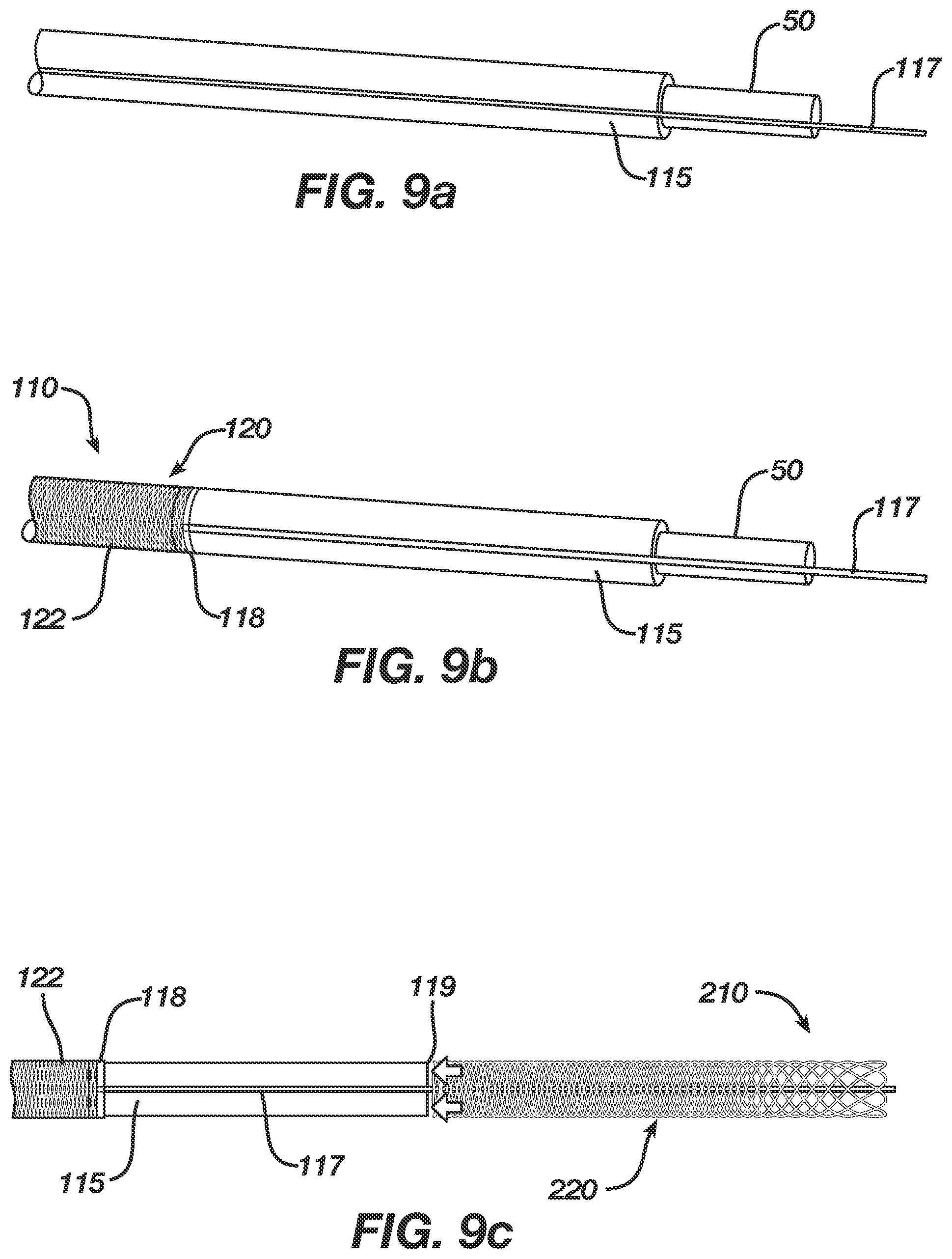 Patent US12496080 Figure 9 – Super-bore catheter with braid supported flared tip