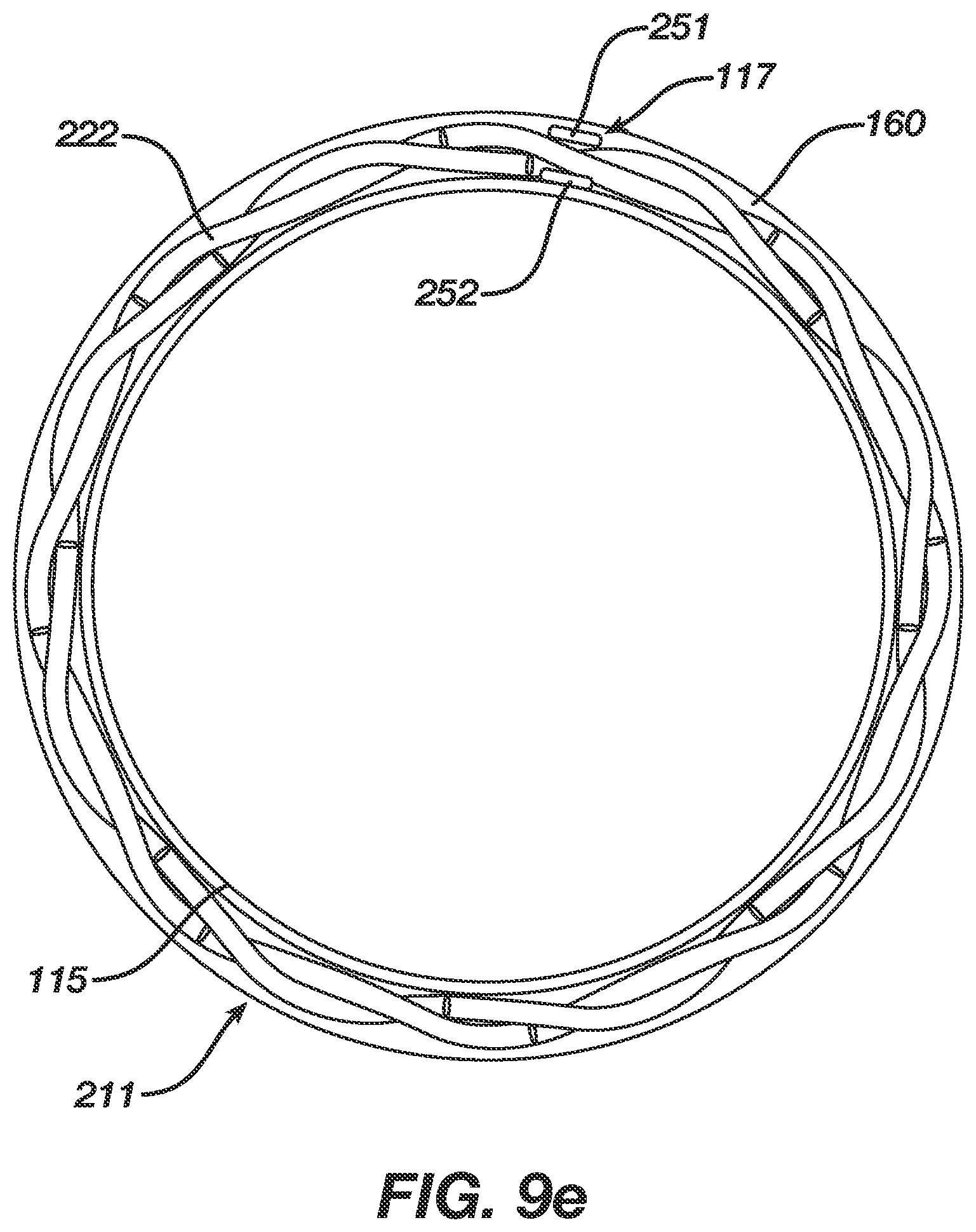 Patent US12496080 Figure 11 – Super-bore catheter with braid supported flared tip