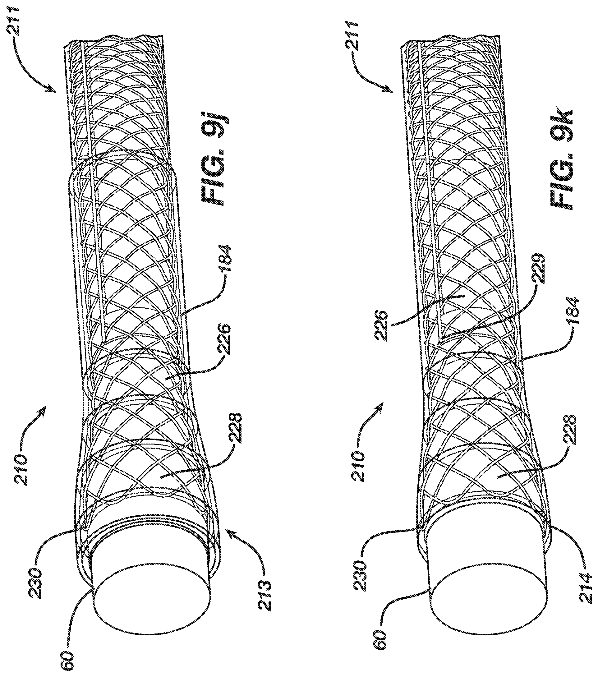 Patent US12496080 Figure 14 – Super-bore catheter with braid supported flared tip