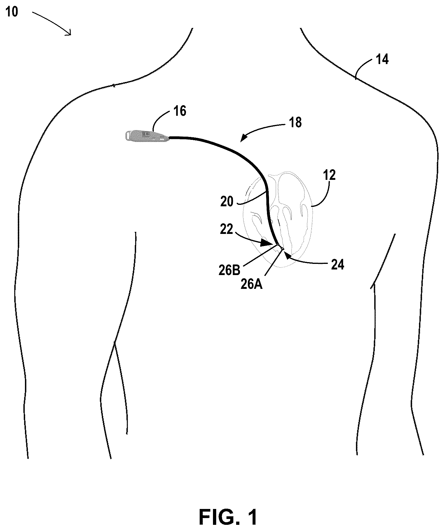 Patent US12496084 Figure 1 – Tunneling and insertion tool for implantable medical device