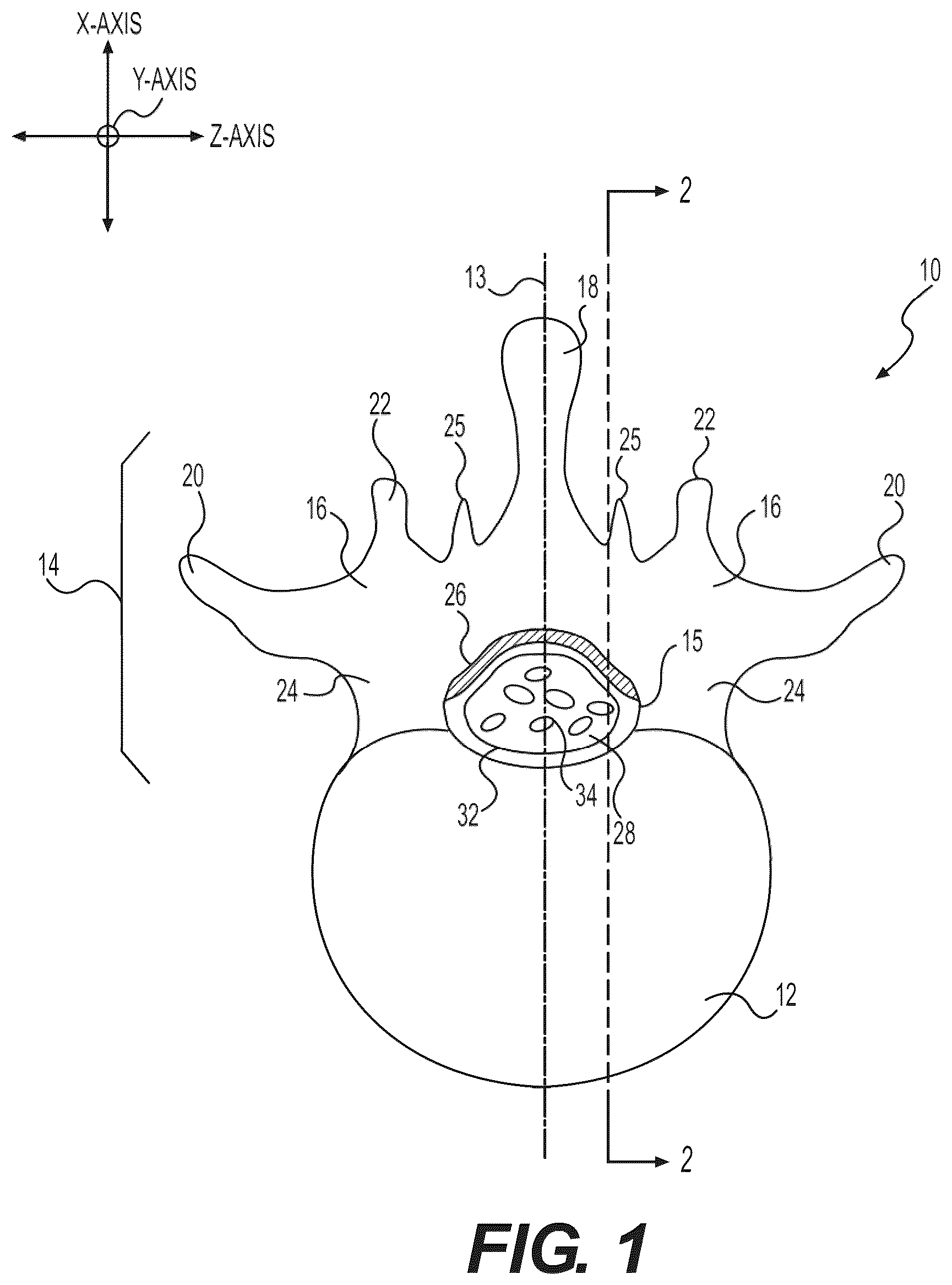 Patent US12496085 Figure 1 – Percutaneous lateral recess resection methods and instruments