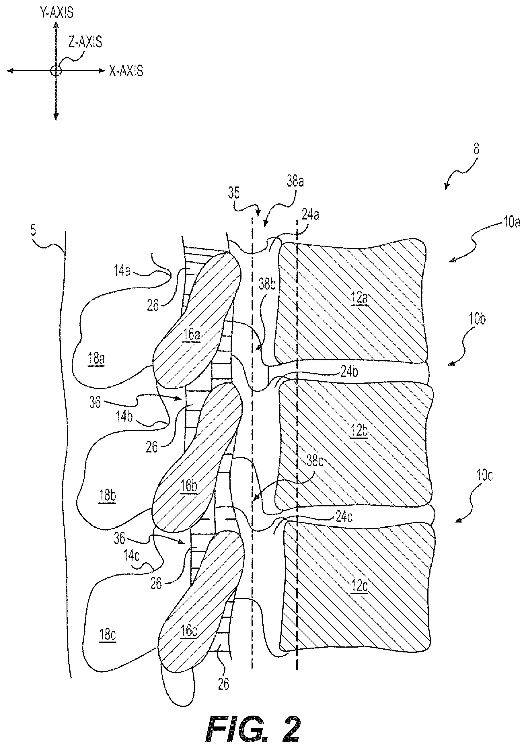 Patent US12496085 Figure 2 – Percutaneous lateral recess resection methods and instruments