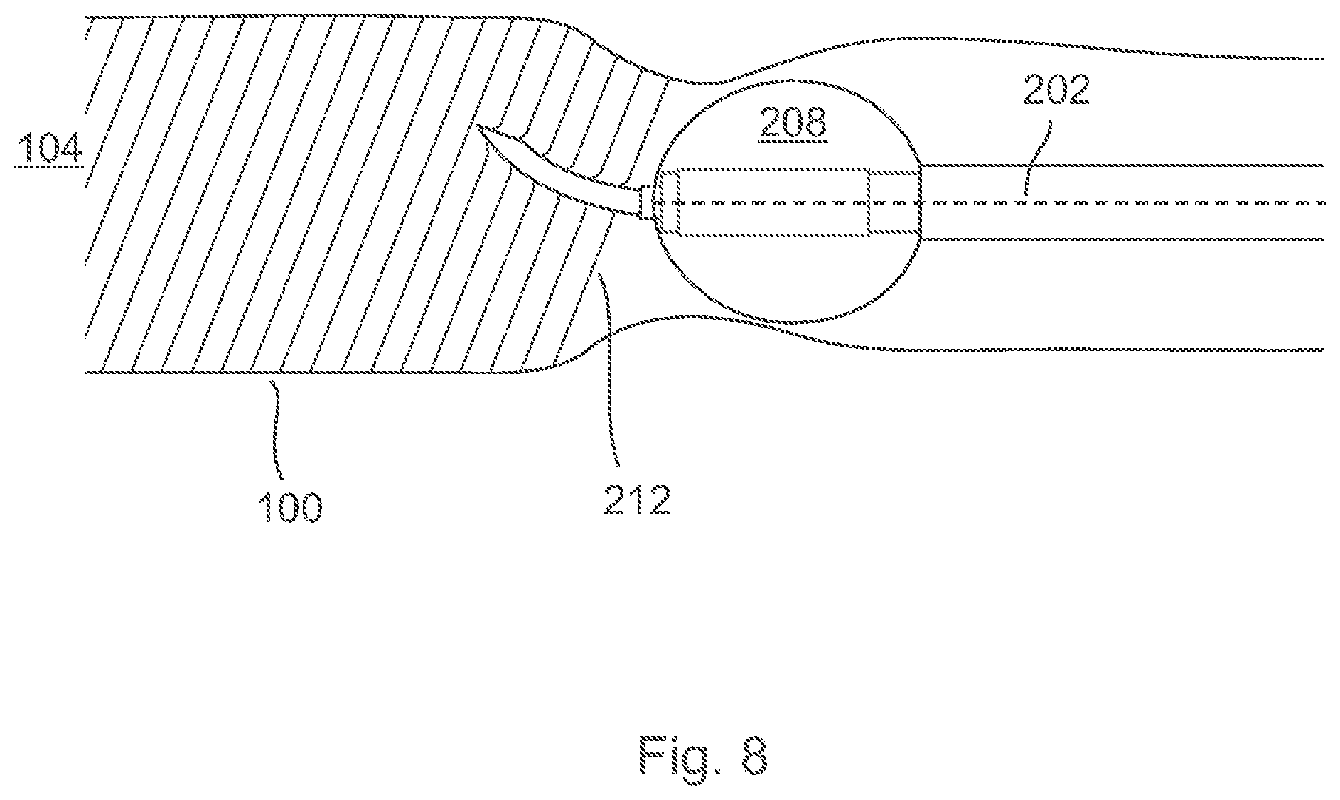 Patent US12496089 Figure 8 – Vessel blockage passing