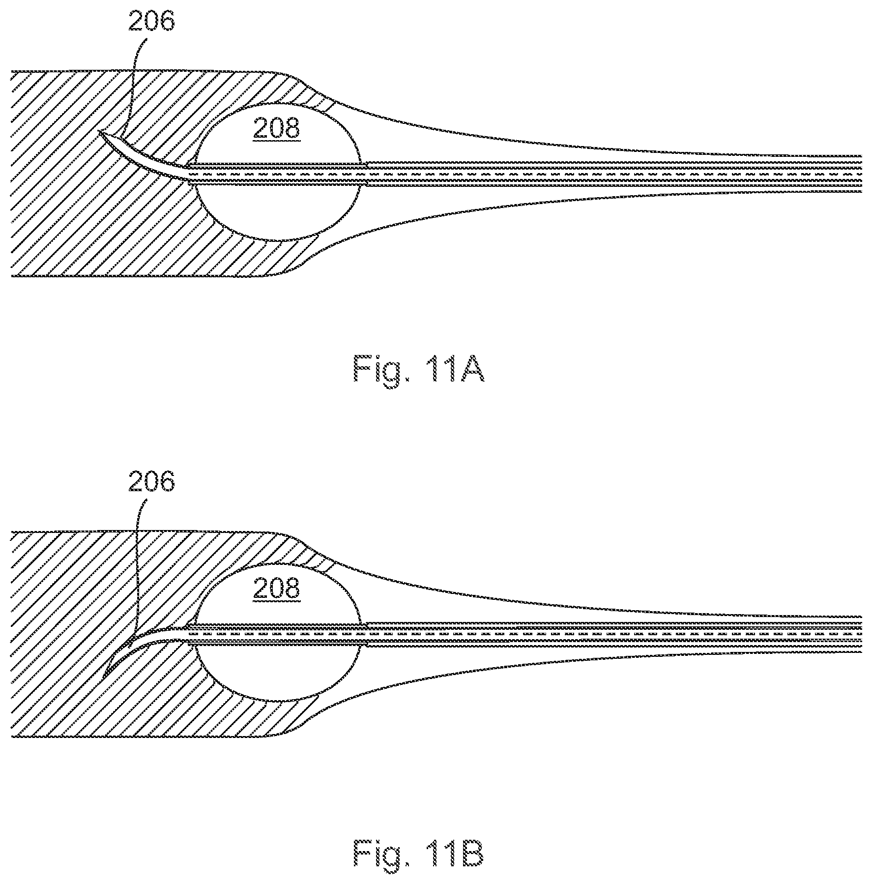 Patent US12496089 Figure 11 – Vessel blockage passing