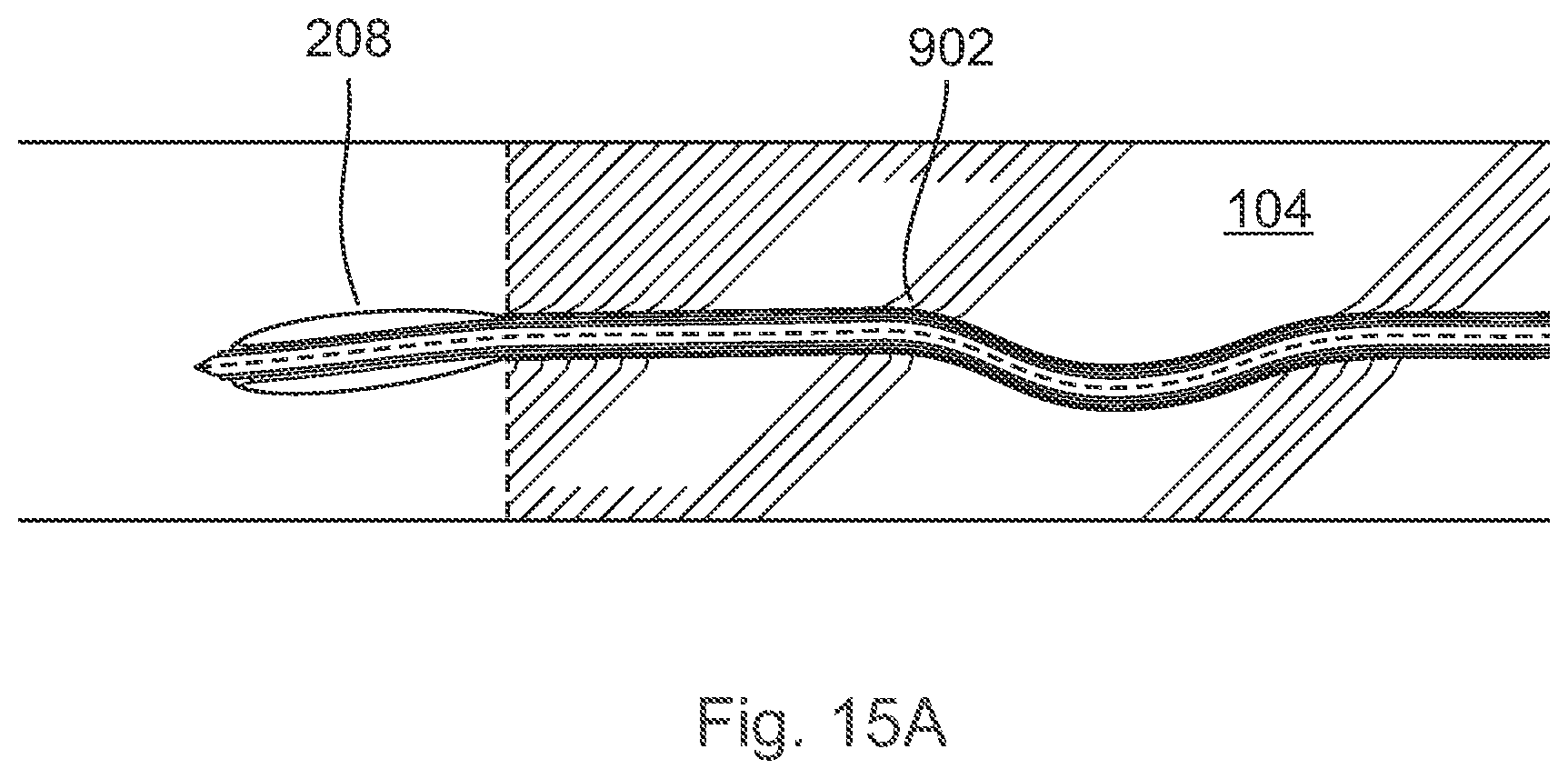 Patent US12496089 Figure 15 – Vessel blockage passing