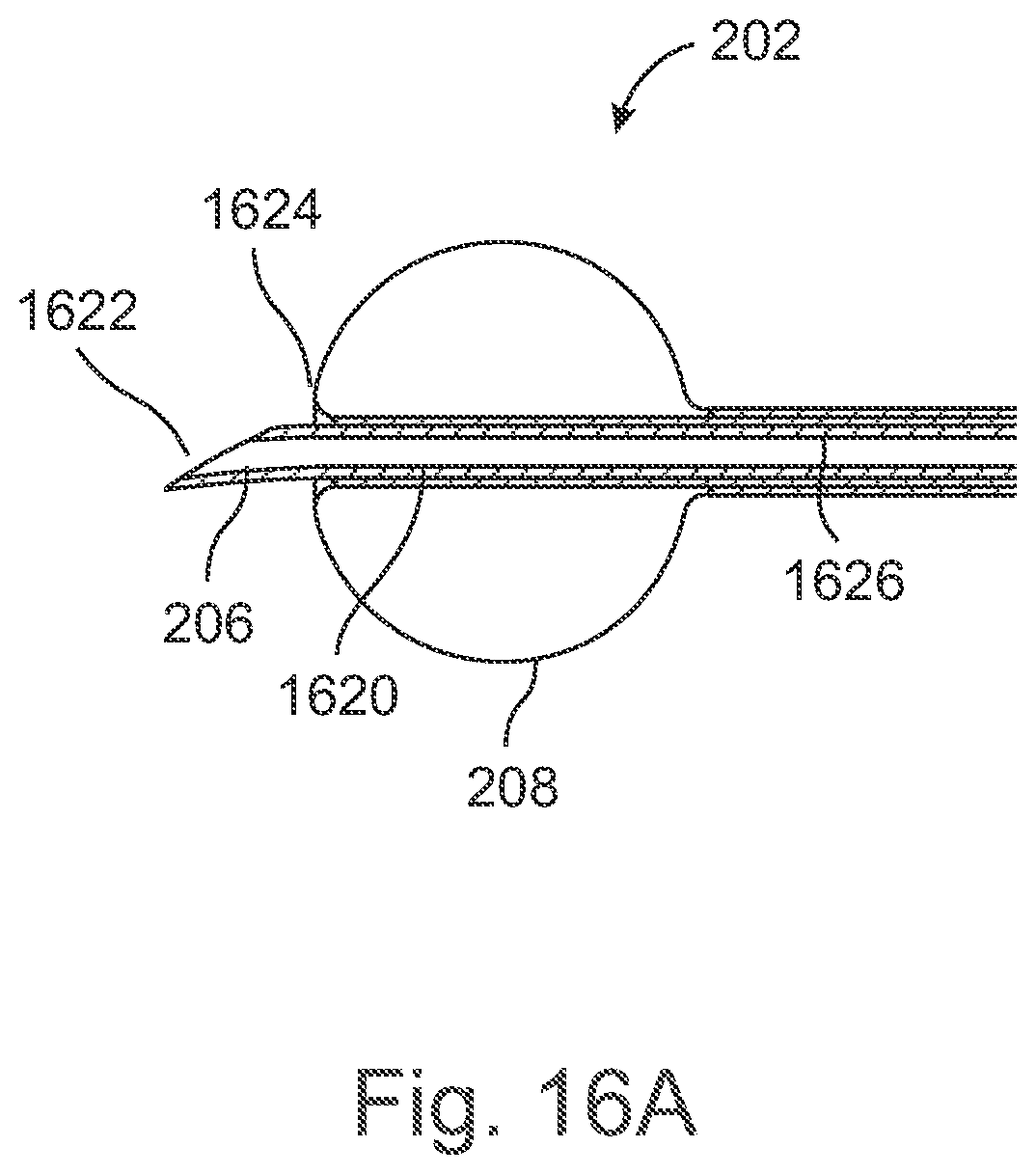Patent US12496089 Figure 17 – Vessel blockage passing