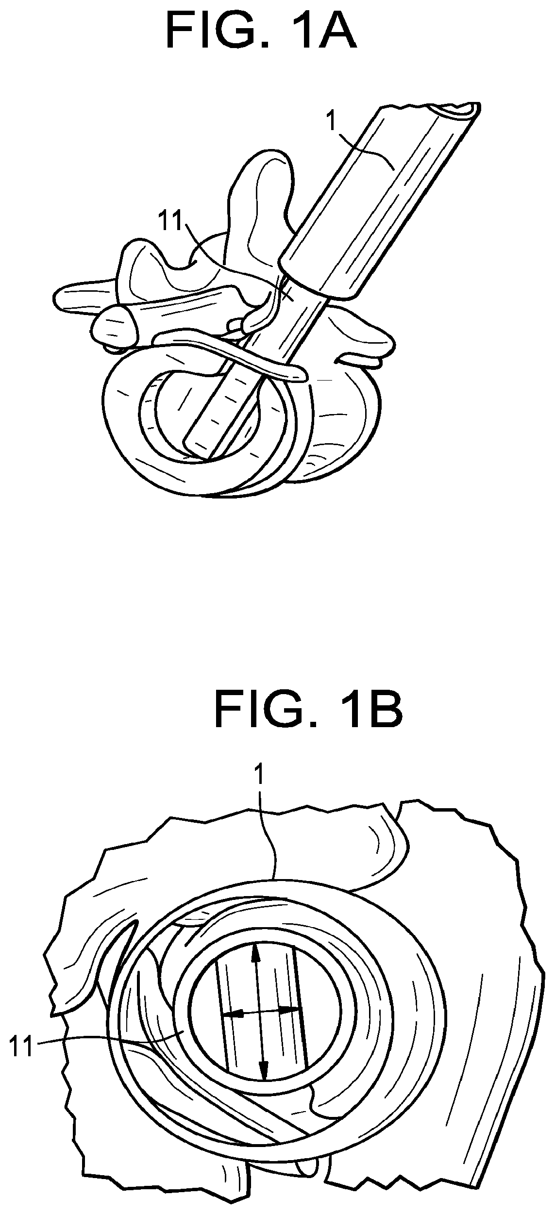 Patent US12496093 Figure 1 – Multi-shield spinal access system