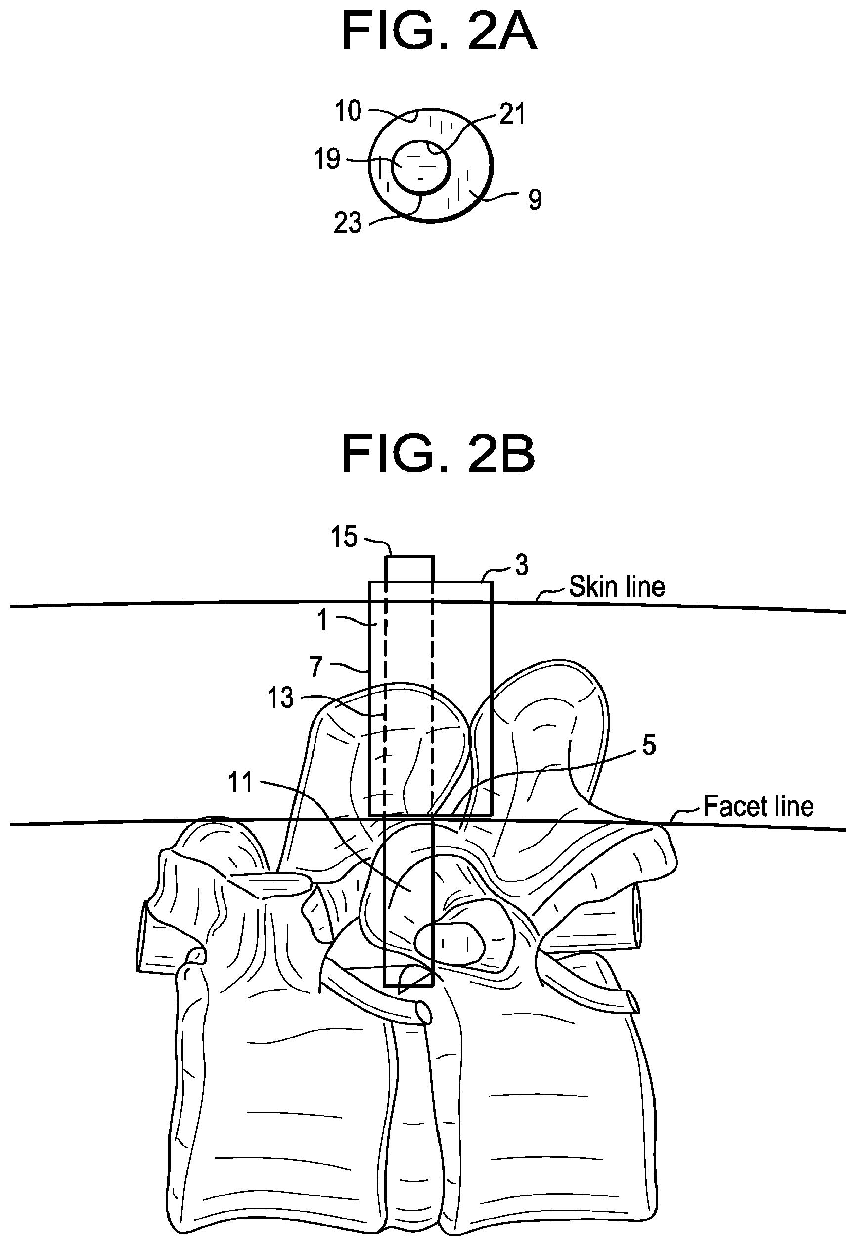 Patent US12496093 Figure 2 – Multi-shield spinal access system