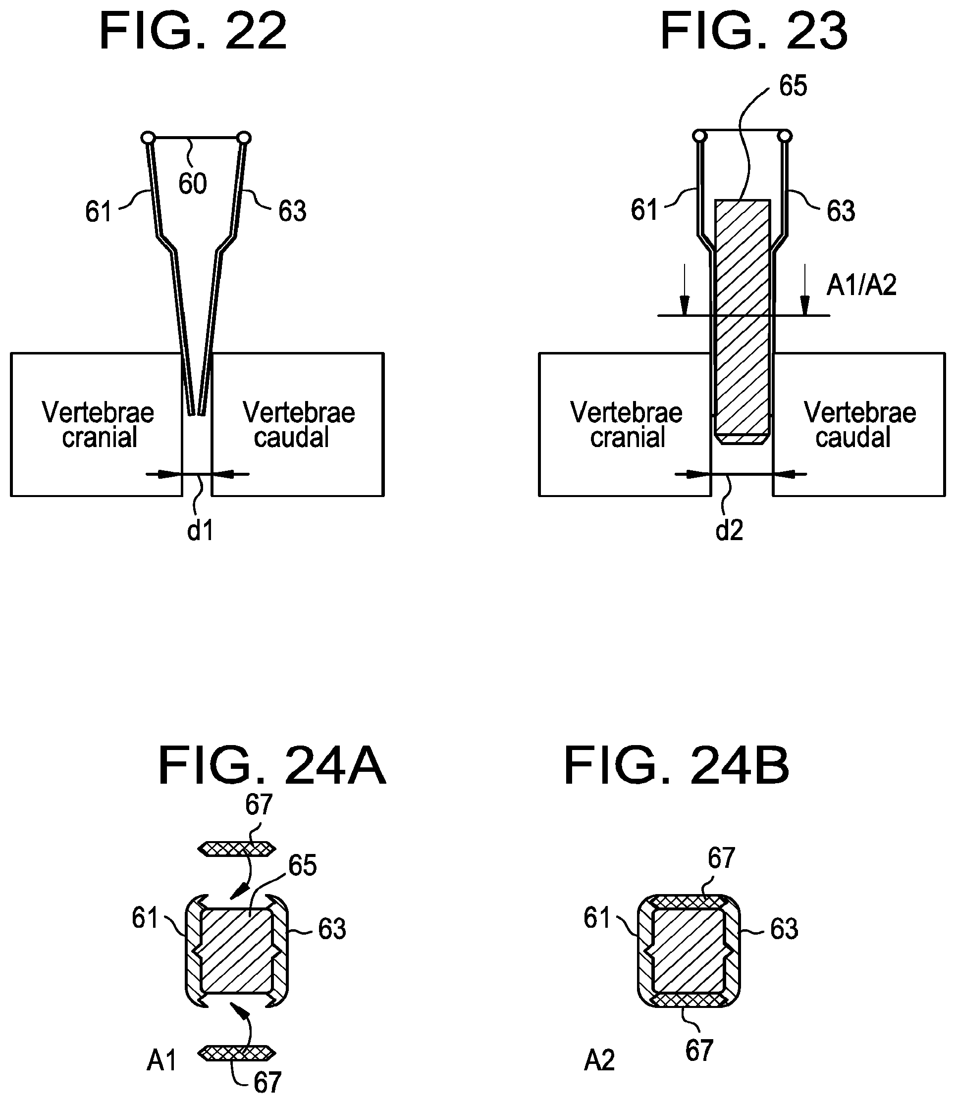 Patent US12496093 Figure 15 – Multi-shield spinal access system