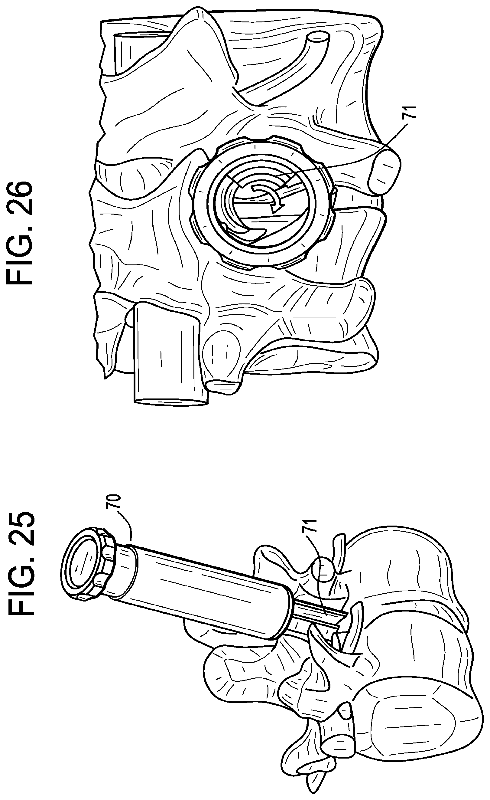 Patent US12496093 Figure 16 – Multi-shield spinal access system