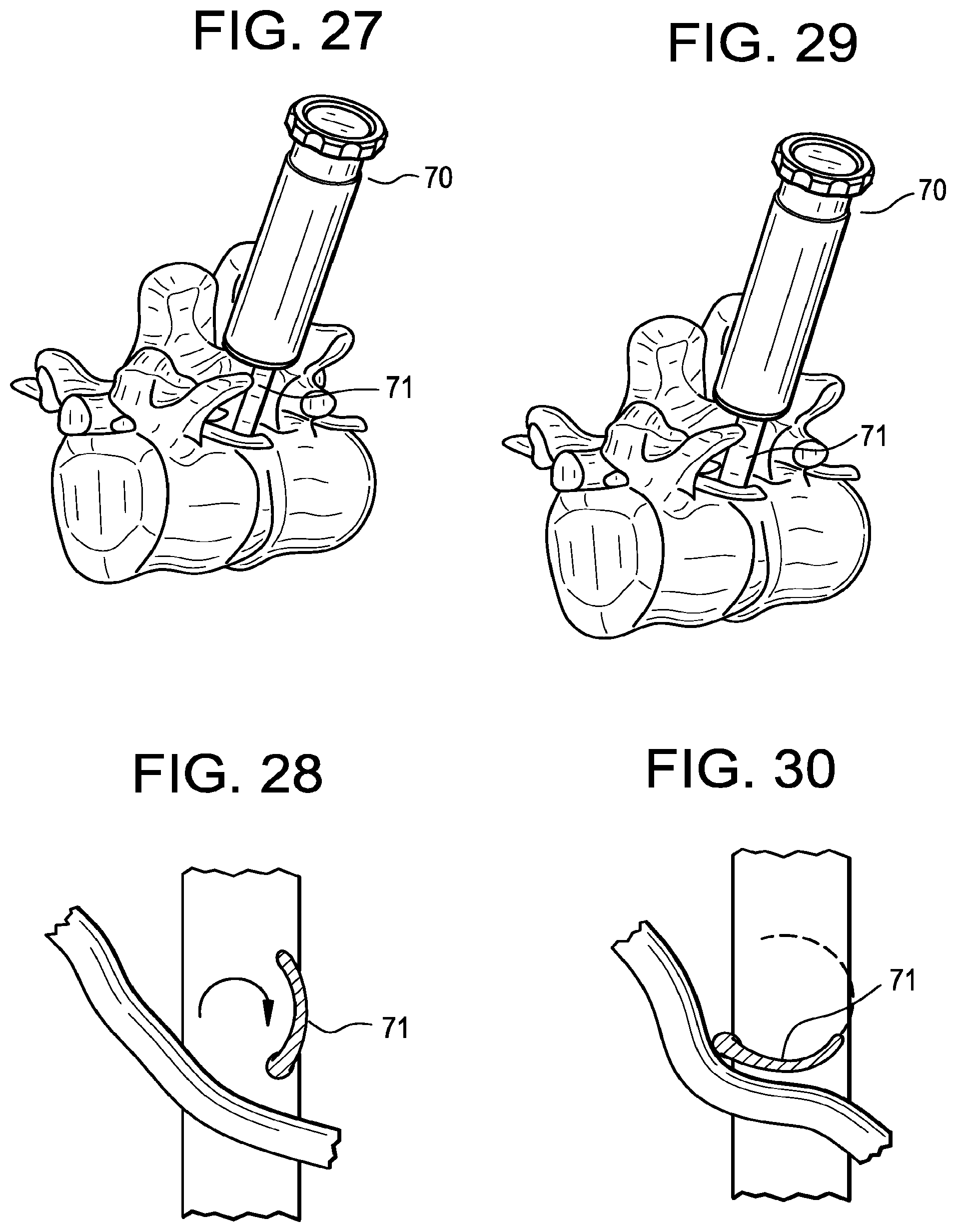 Patent US12496093 Figure 17 – Multi-shield spinal access system
