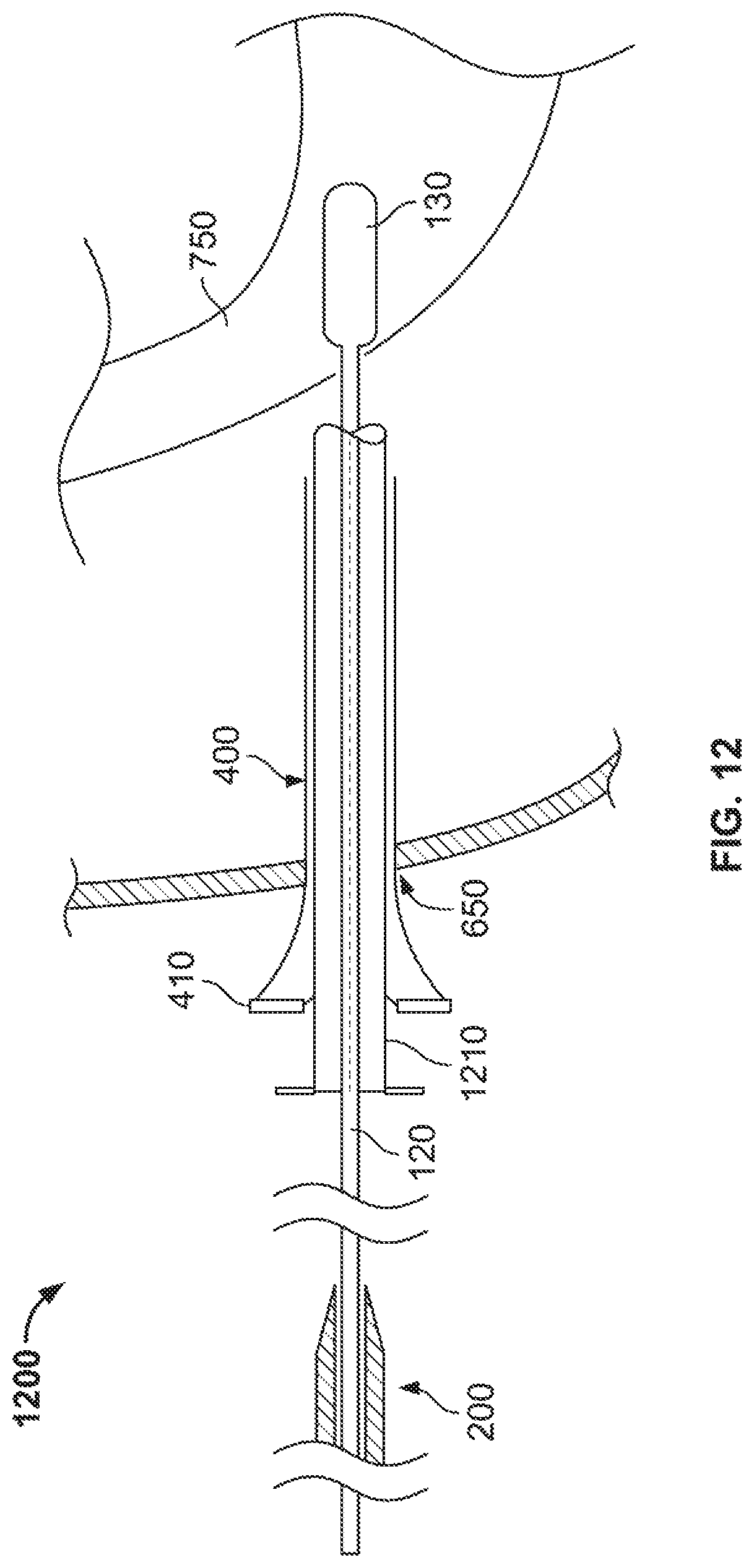 Patent US12496095 Figure 11 – Integrated expandable access for medical device introducer
