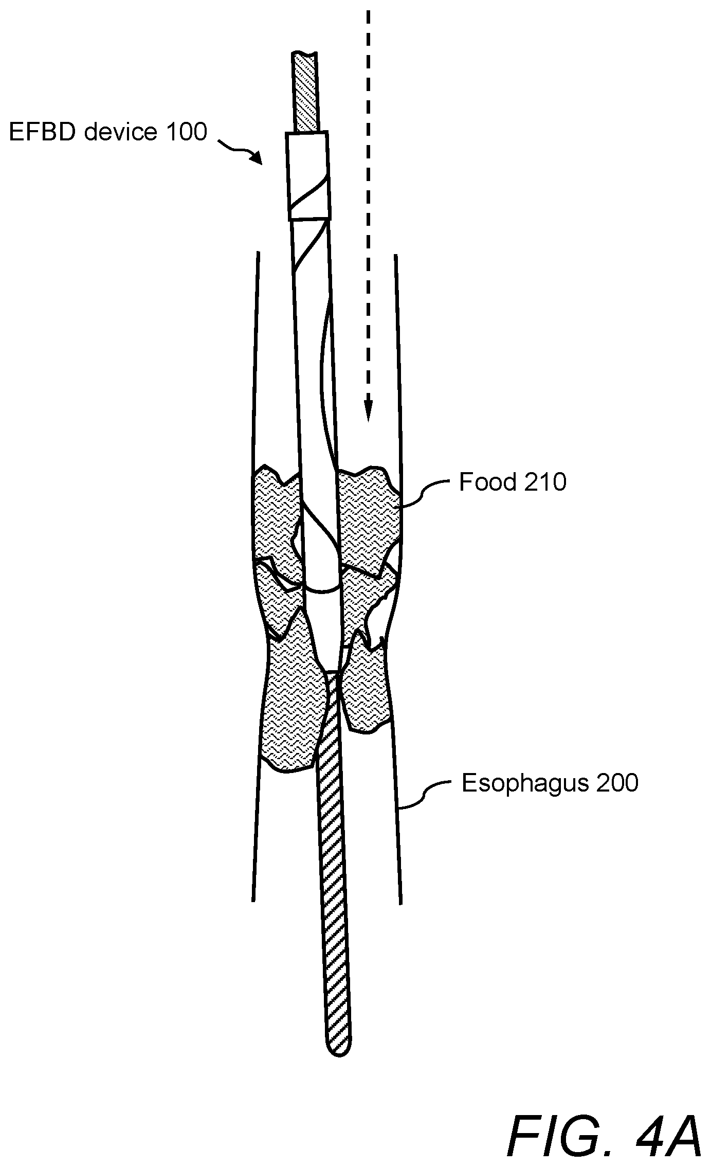 Patent US12496096 Figure 4 – Esophageal food bolus dislodger device and method of using same