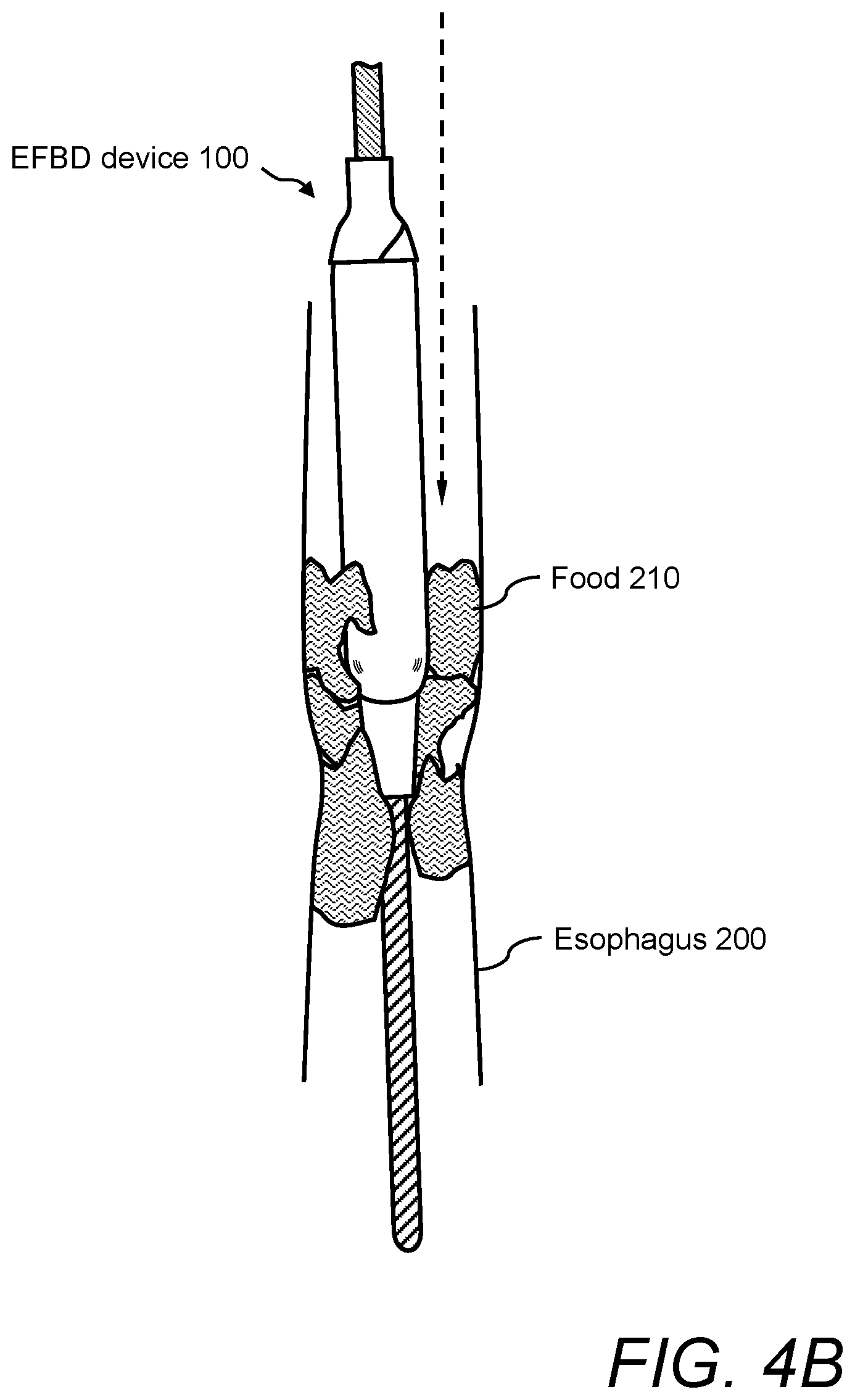 Patent US12496096 Figure 5 – Esophageal food bolus dislodger device and method of using same