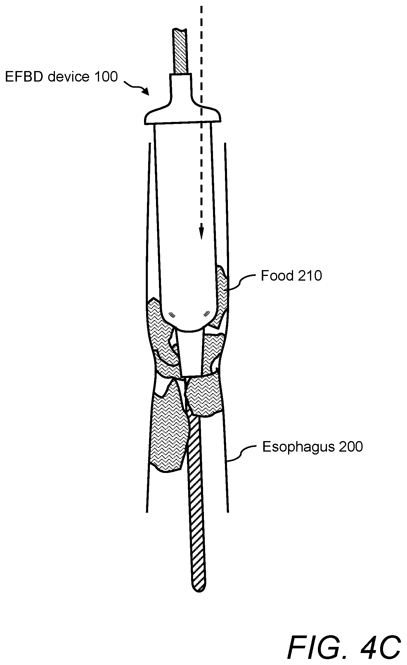 Patent US12496096 Figure 6 – Esophageal food bolus dislodger device and method of using same