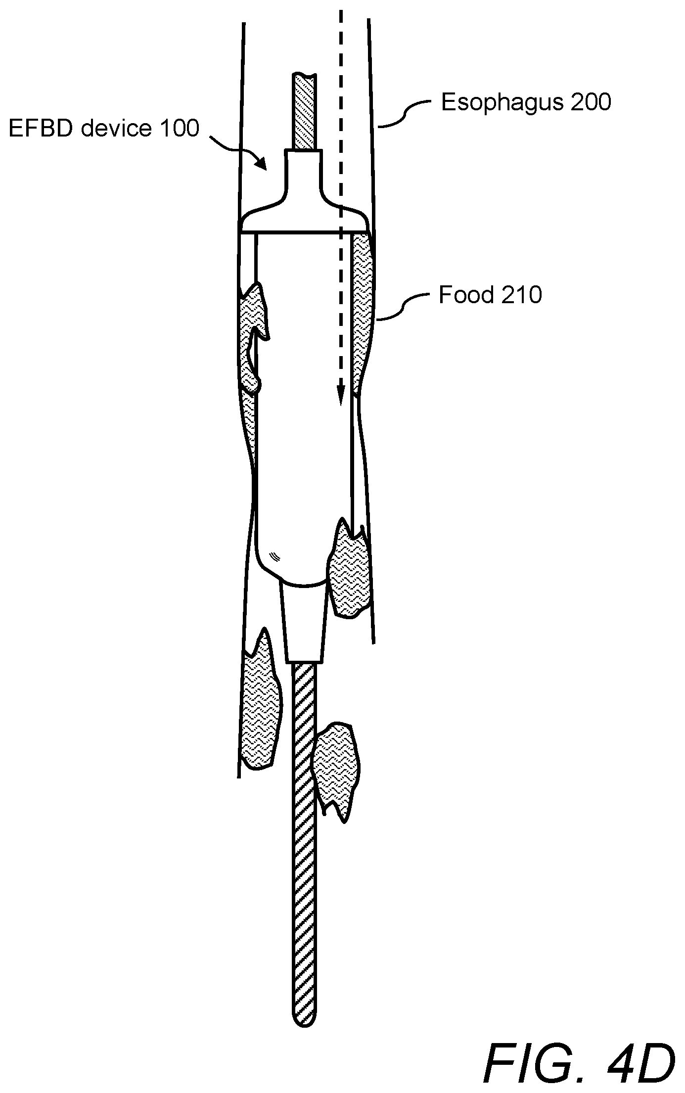 Patent US12496096 Figure 7 – Esophageal food bolus dislodger device and method of using same