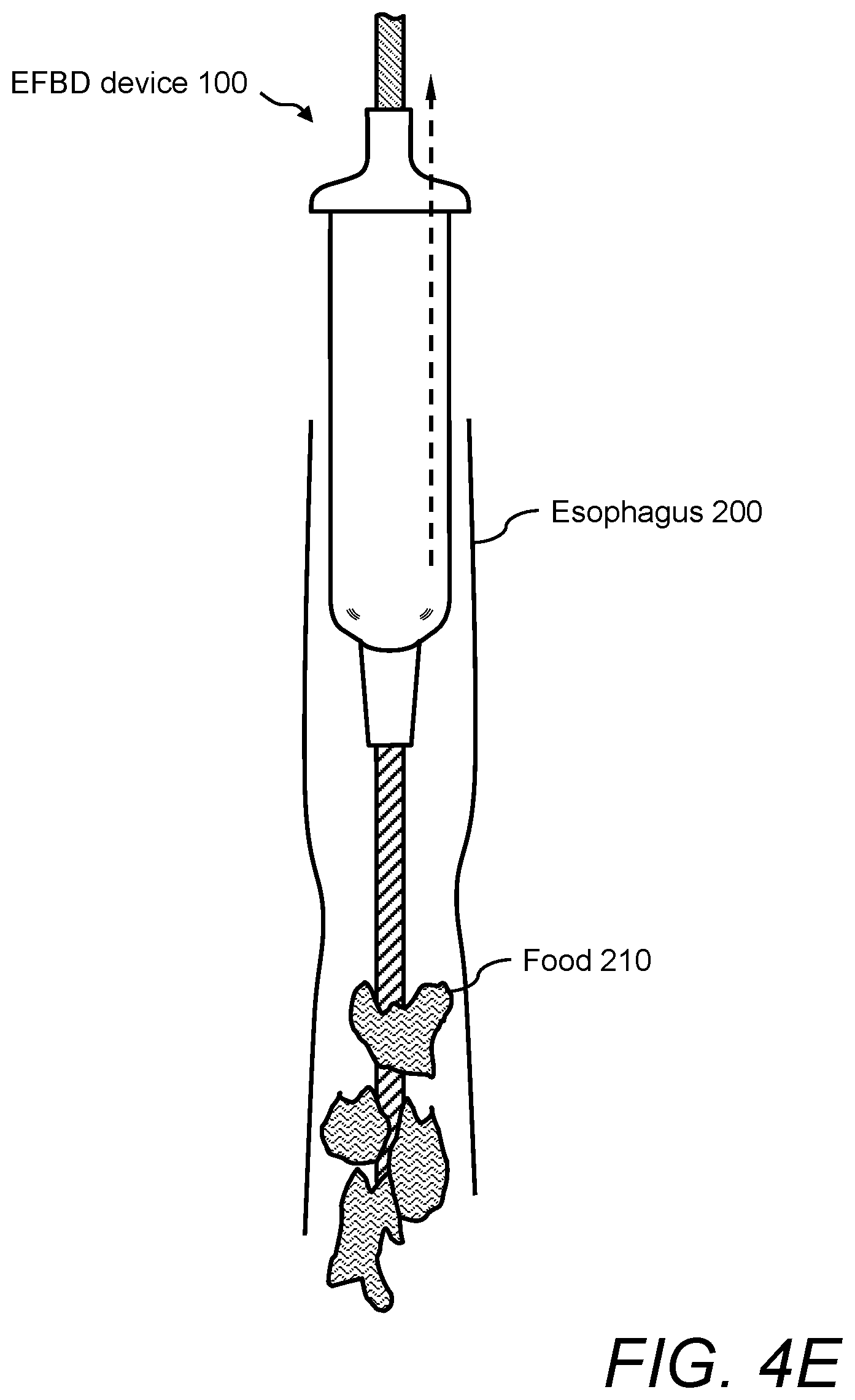 Patent US12496096 Figure 8 – Esophageal food bolus dislodger device and method of using same
