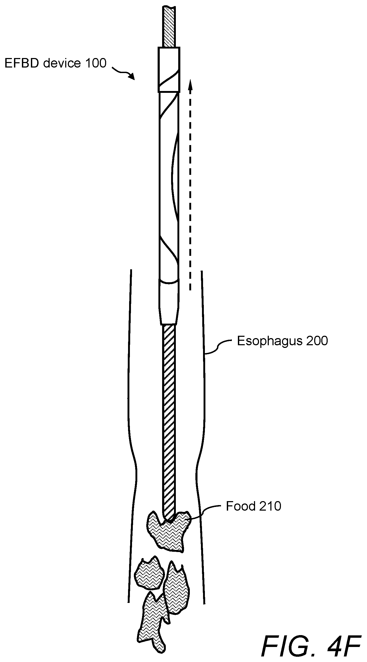 Patent US12496096 Figure 9 – Esophageal food bolus dislodger device and method of using same