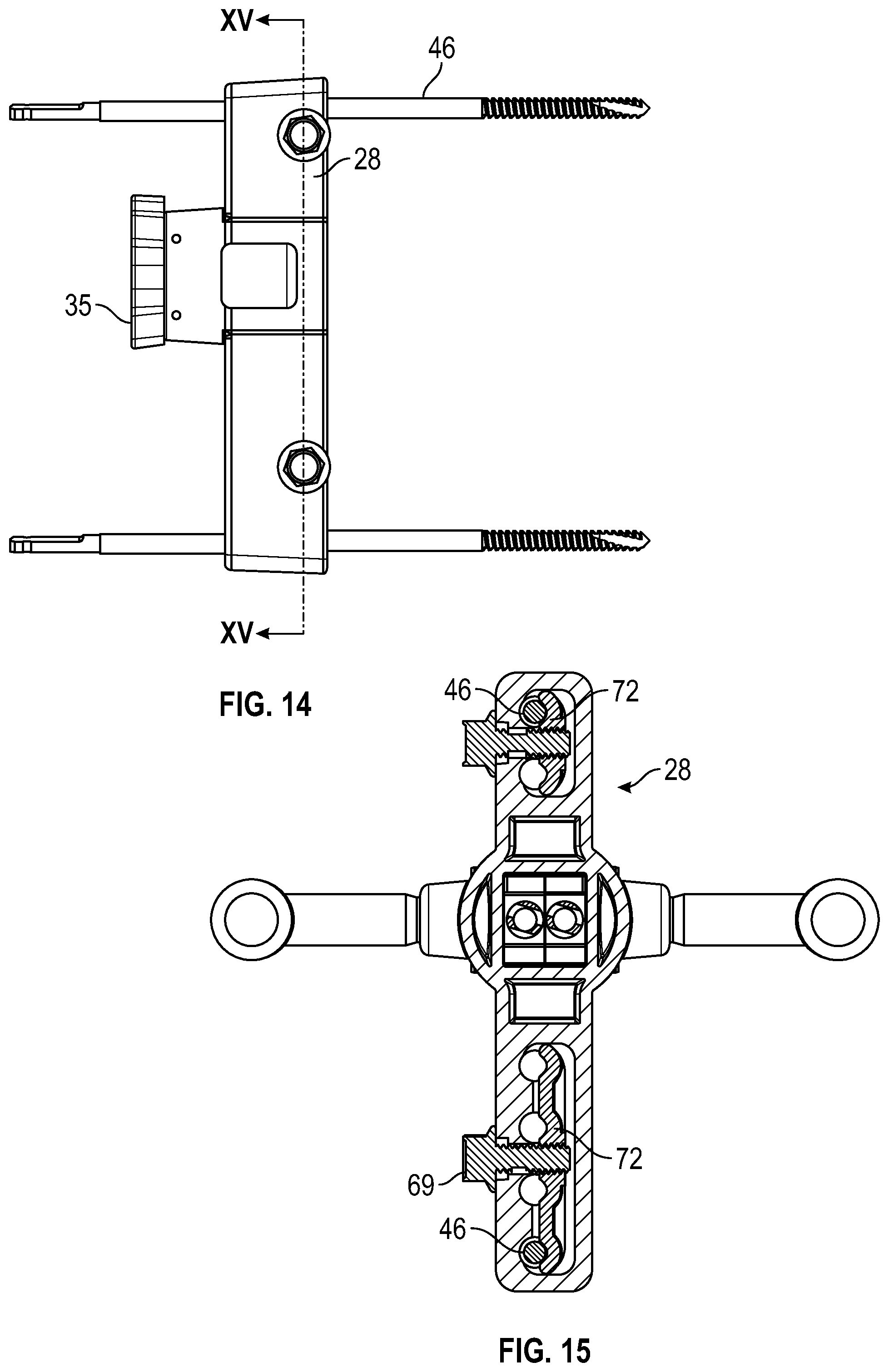 Patent US12496098 Figure 13 – Bone fixator with removable portion