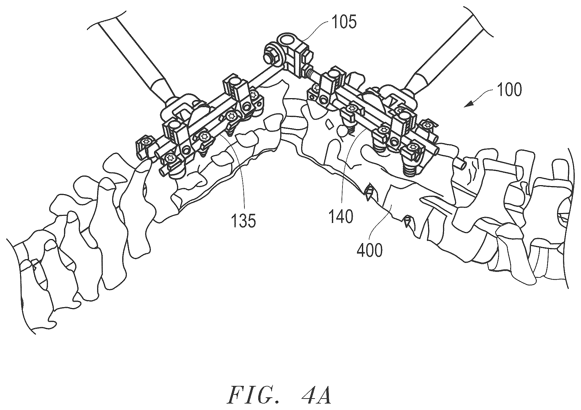 Patent US12496100 Figure 17 – Hinge-link spinal correction device and method