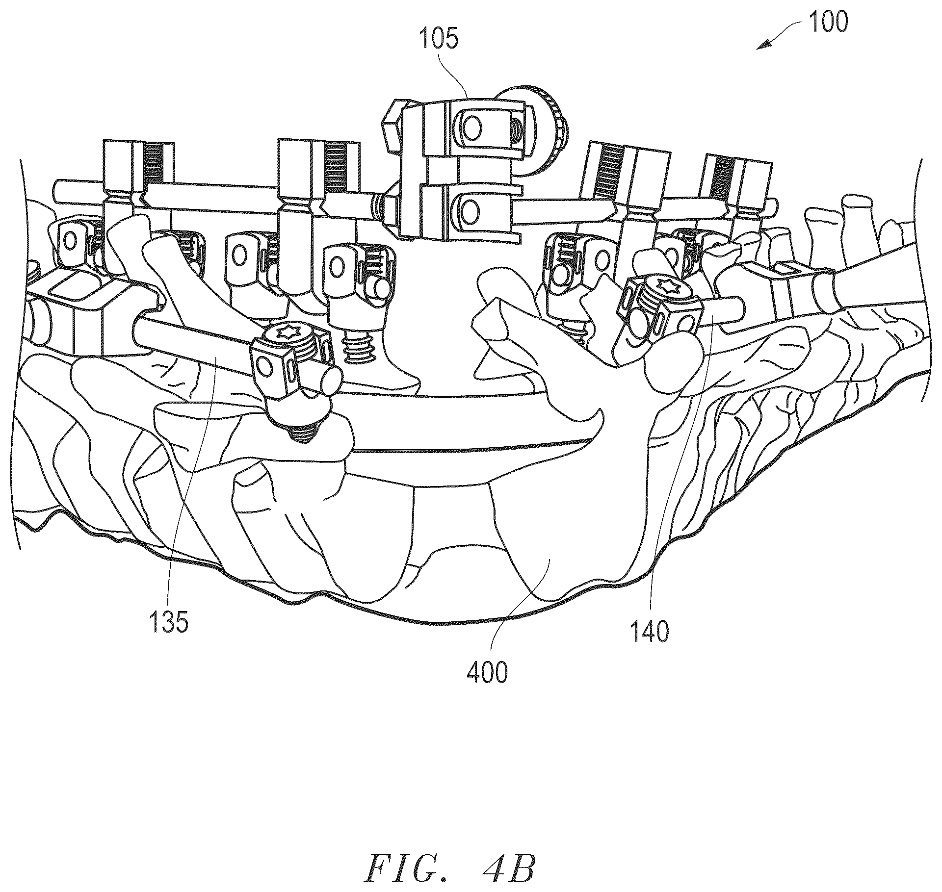 Patent US12496100 Figure 18 – Hinge-link spinal correction device and method