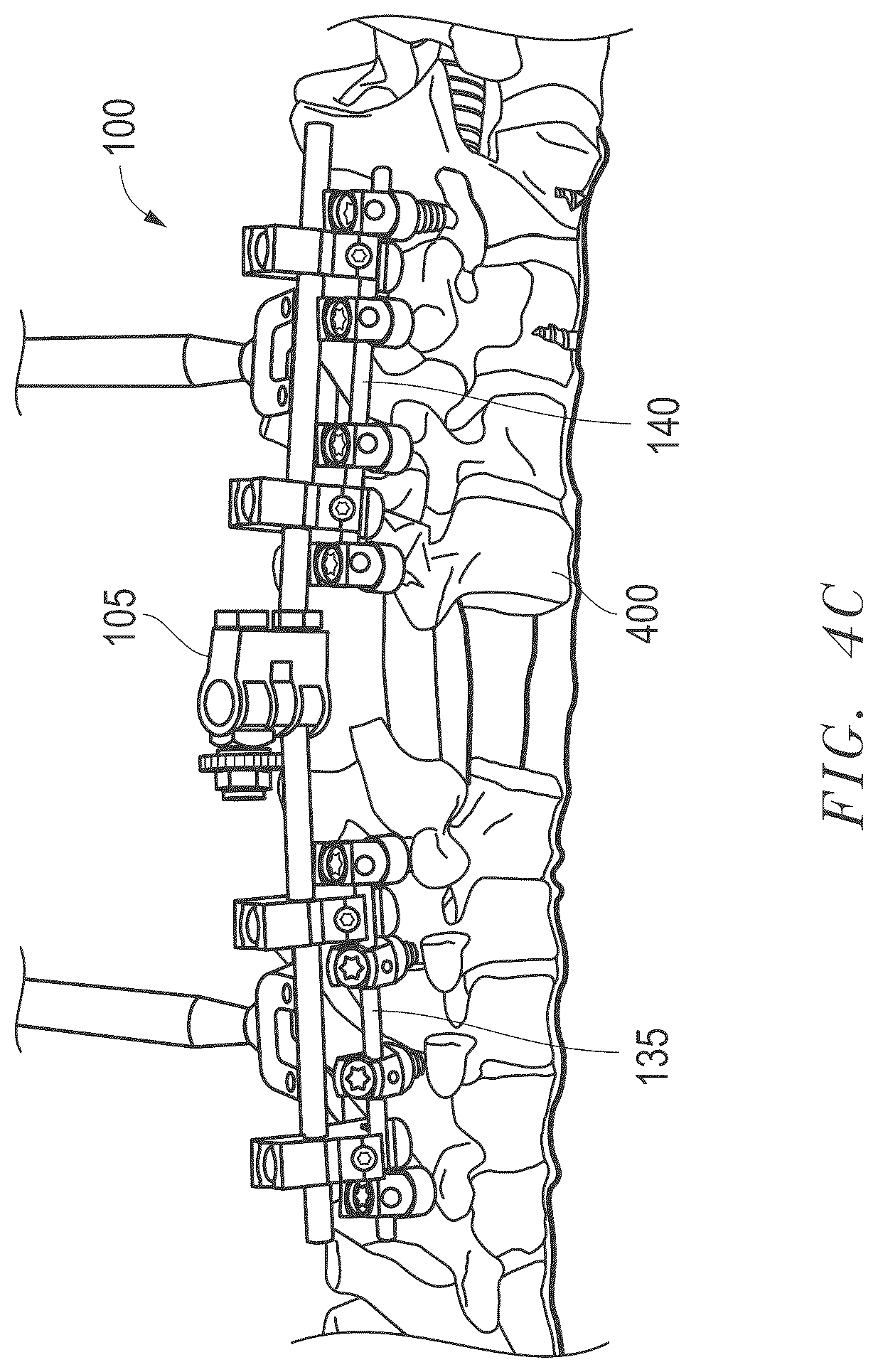 Patent US12496100 Figure 19 – Hinge-link spinal correction device and method