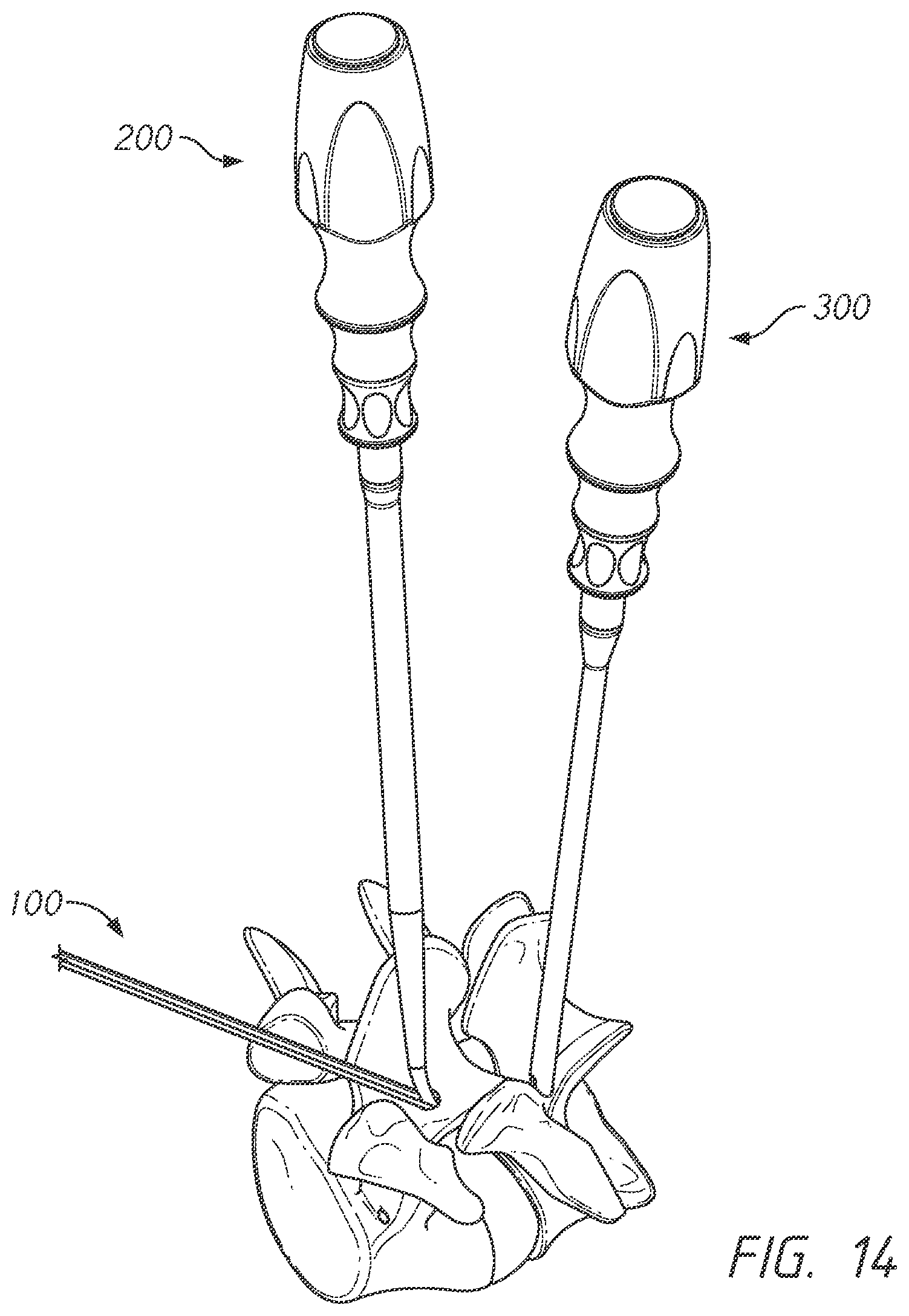 Patent US12496101 Figure 14 – Bone tie and bone tie inserter