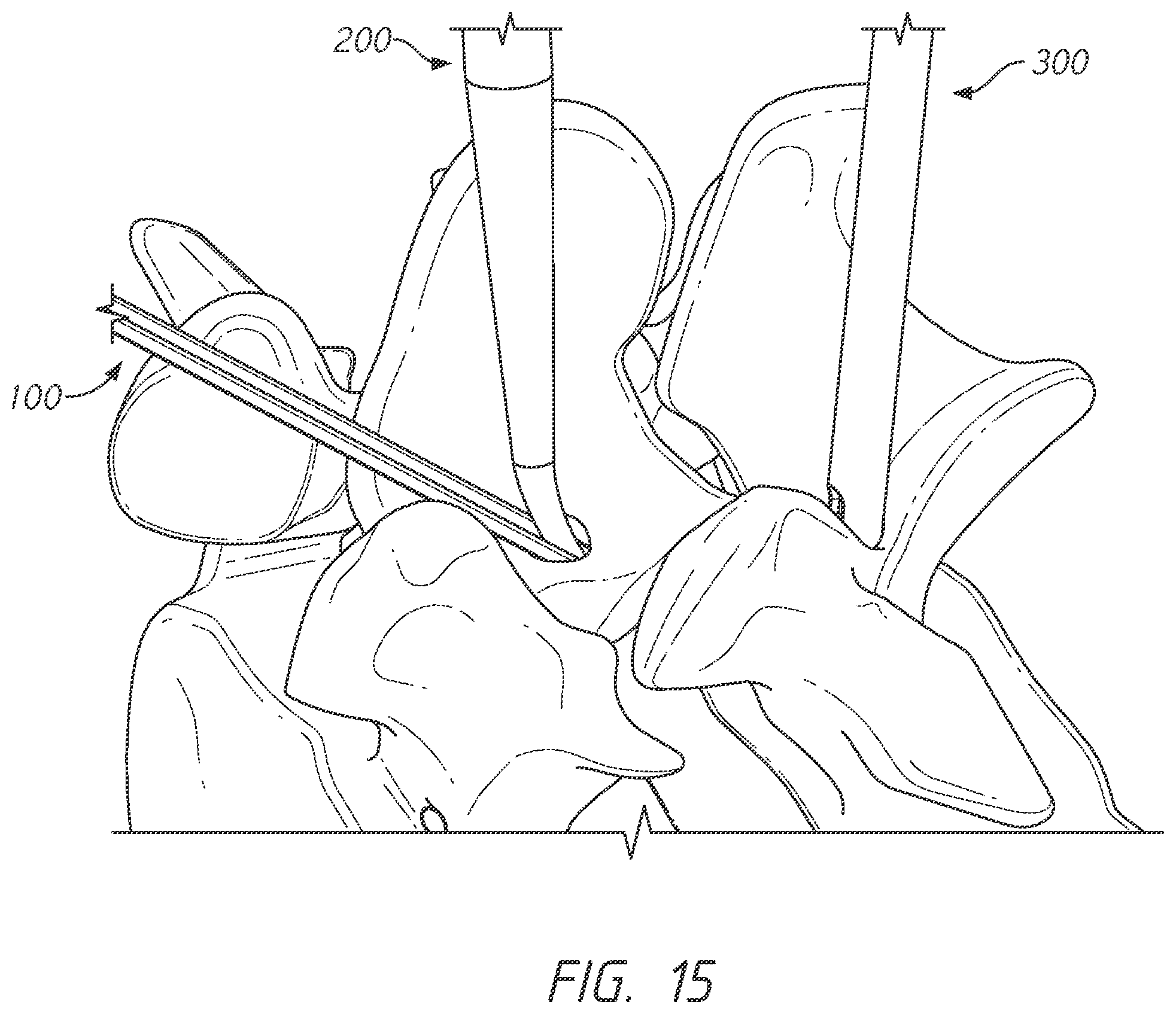 Patent US12496101 Figure 15 – Bone tie and bone tie inserter