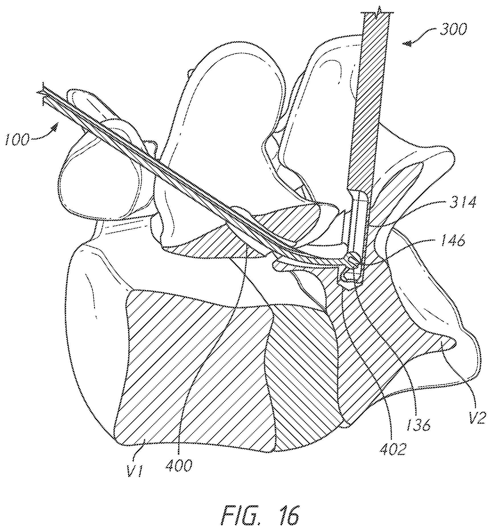 Patent US12496101 Figure 16 – Bone tie and bone tie inserter