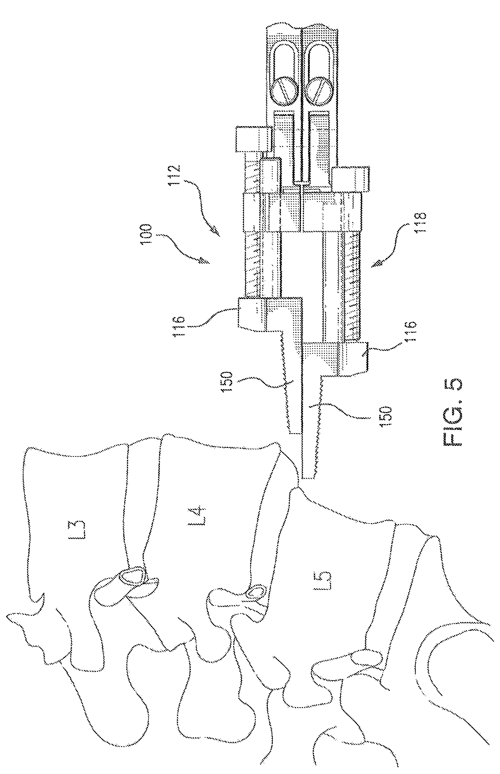 Patent US12496102 Figure 4 – Translational instrumentation for spondylolisthesis and scoliosis reduction