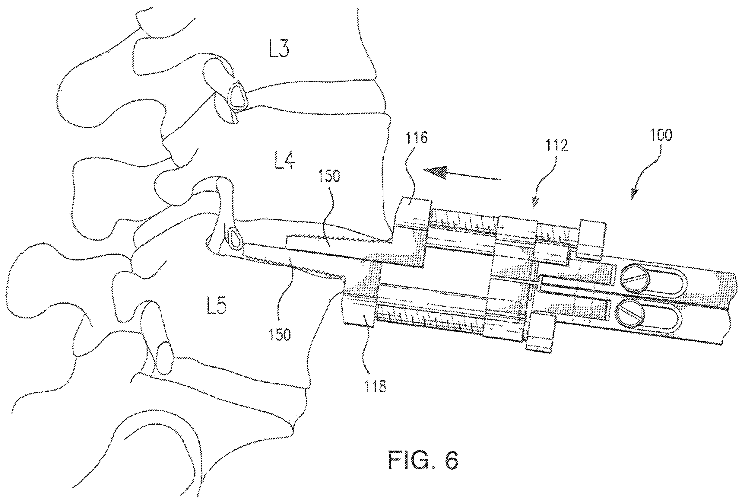 Patent US12496102 Figure 5 – Translational instrumentation for spondylolisthesis and scoliosis reduction