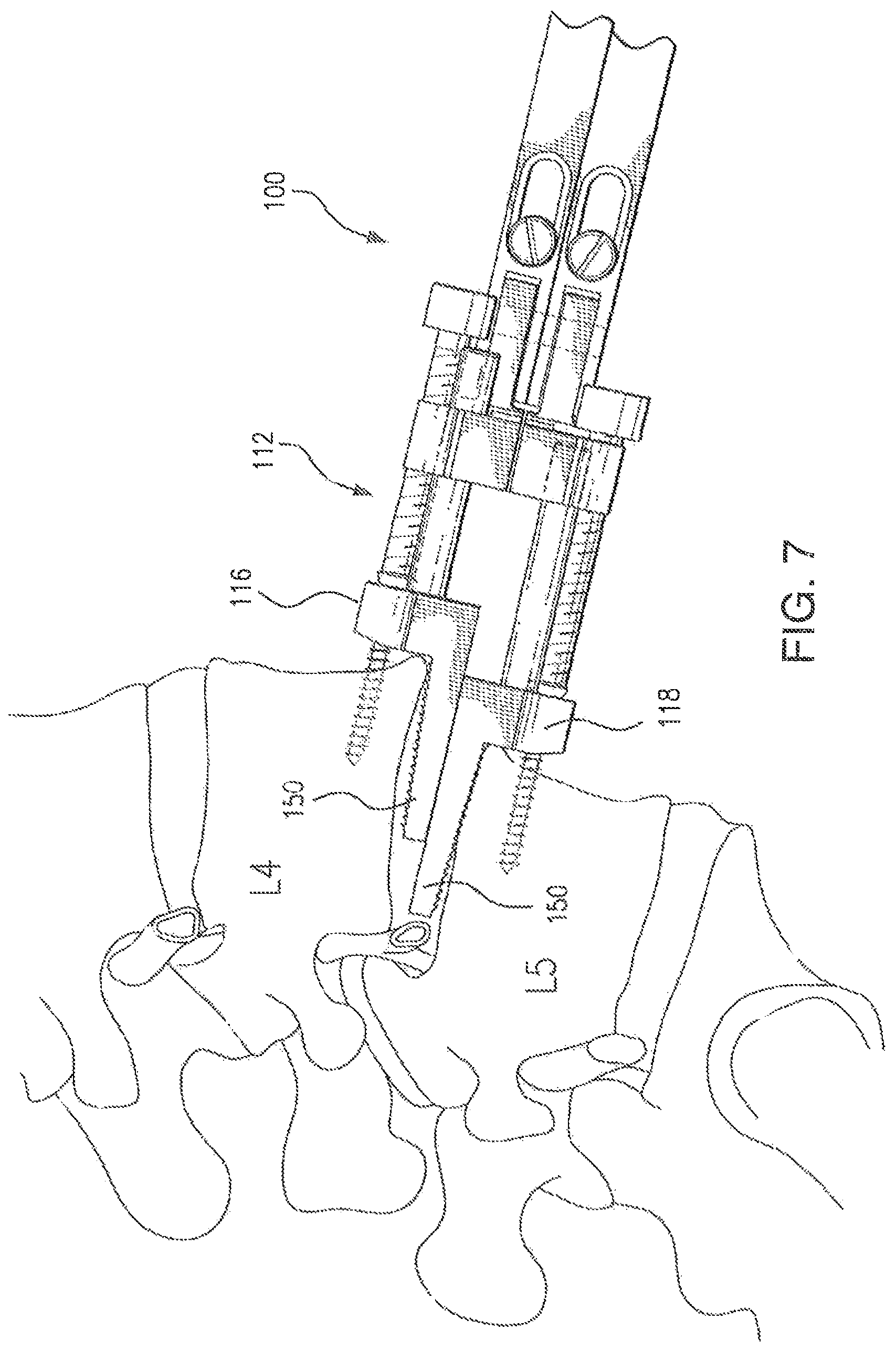 Patent US12496102 Figure 6 – Translational instrumentation for spondylolisthesis and scoliosis reduction