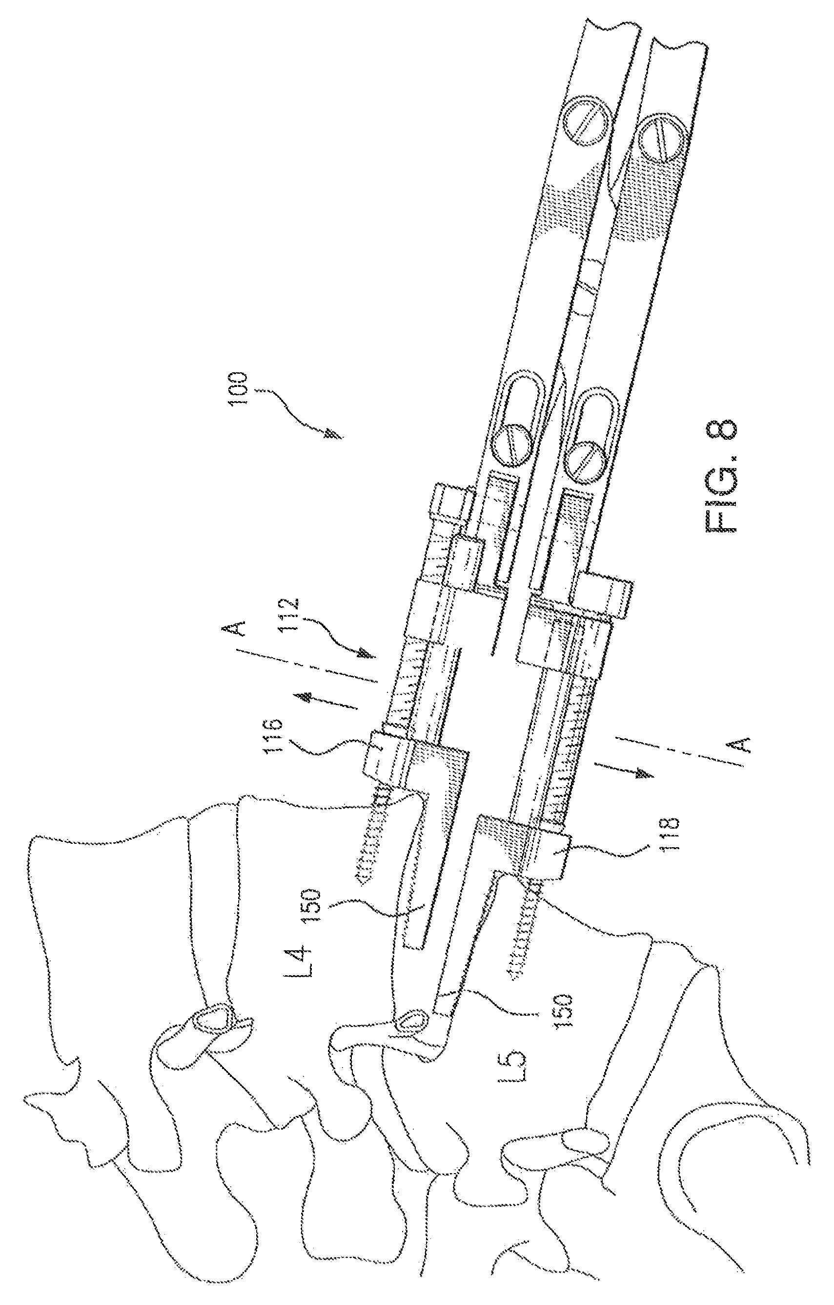 Patent US12496102 Figure 7 – Translational instrumentation for spondylolisthesis and scoliosis reduction