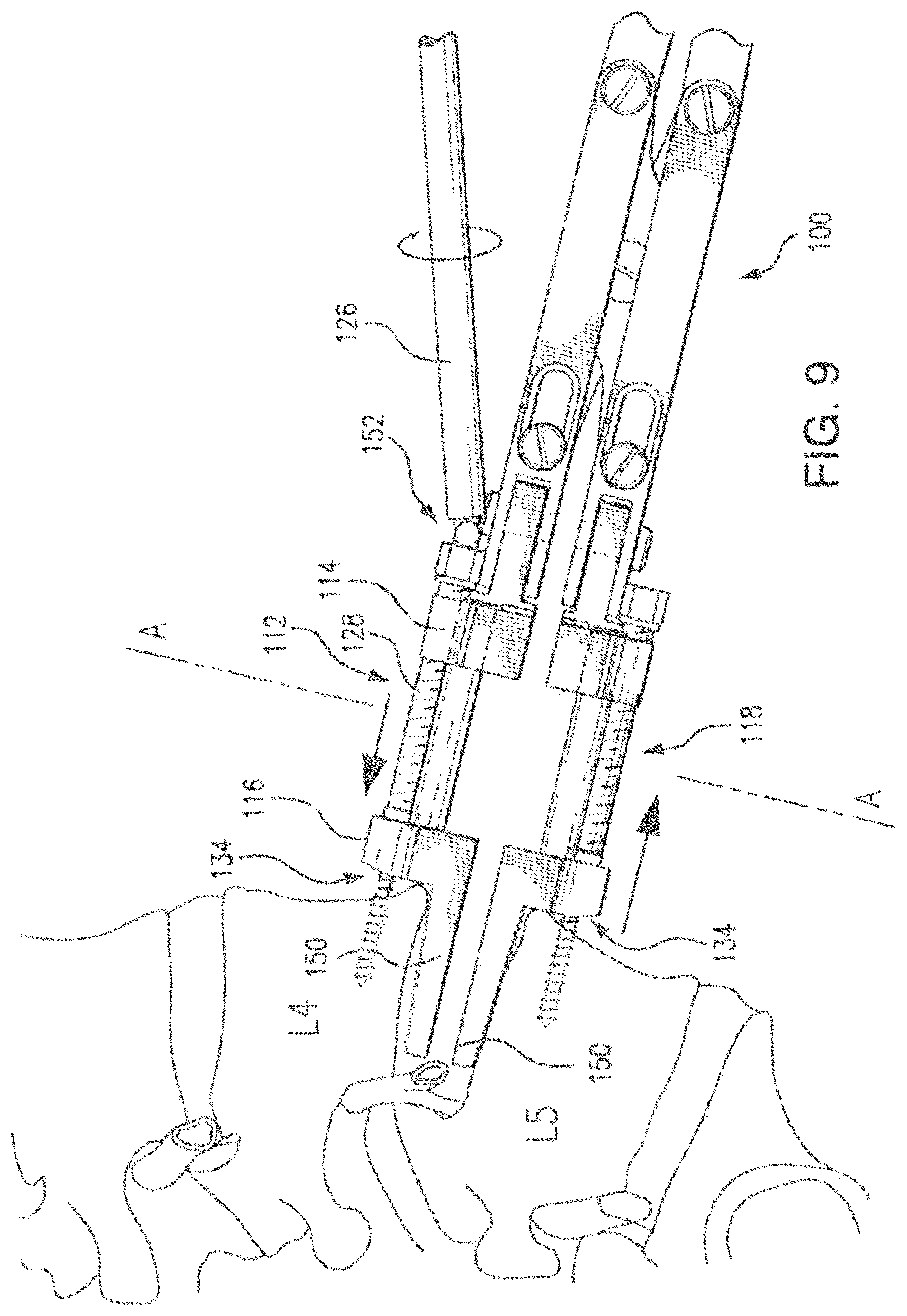 Patent US12496102 Figure 8 – Translational instrumentation for spondylolisthesis and scoliosis reduction