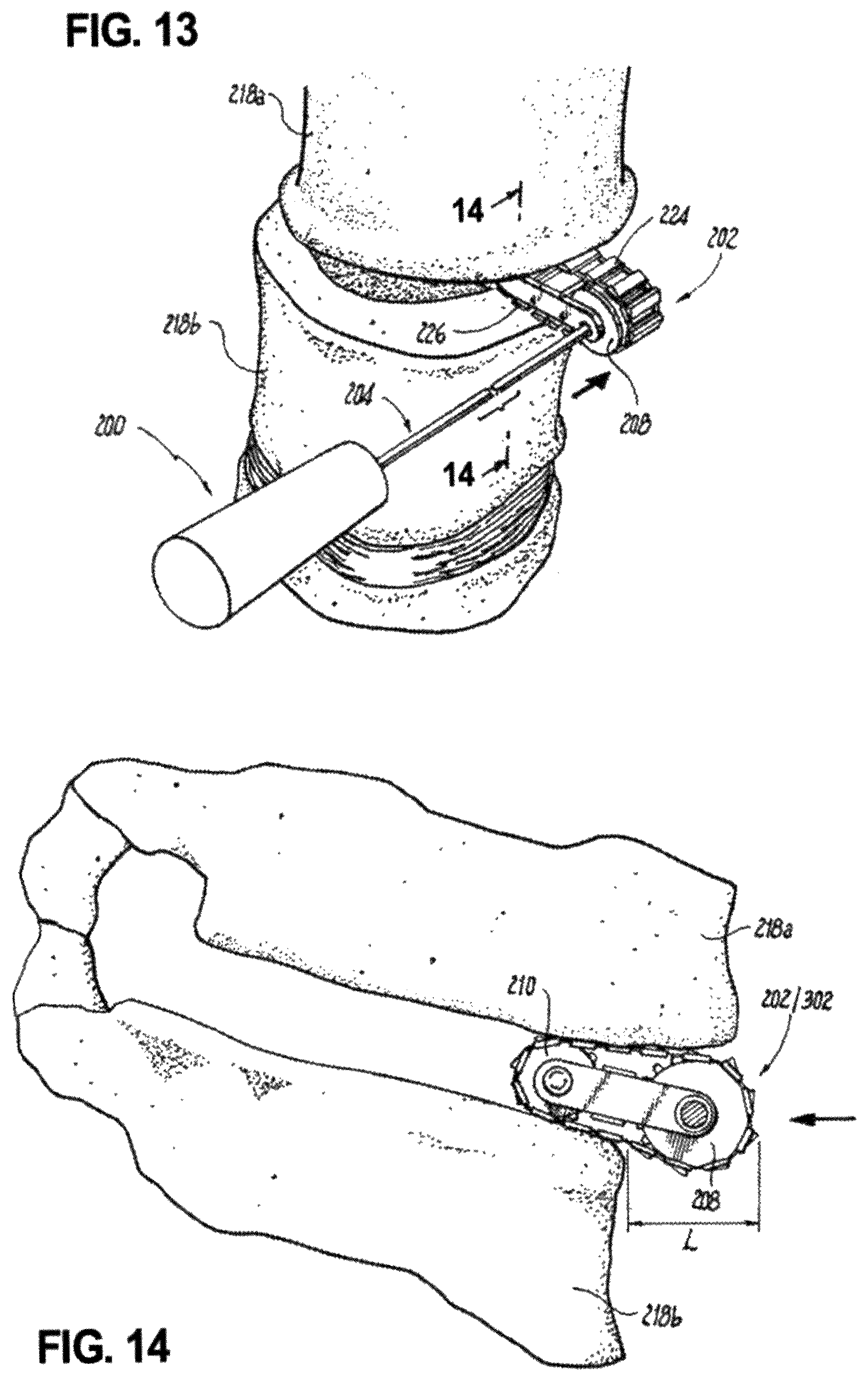 Patent US12496102 Figure 10 – Translational instrumentation for spondylolisthesis and scoliosis reduction