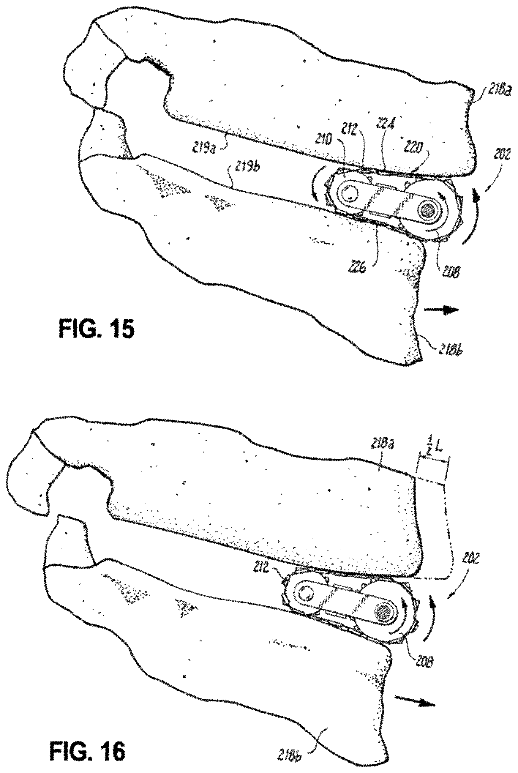 Patent US12496102 Figure 11 – Translational instrumentation for spondylolisthesis and scoliosis reduction