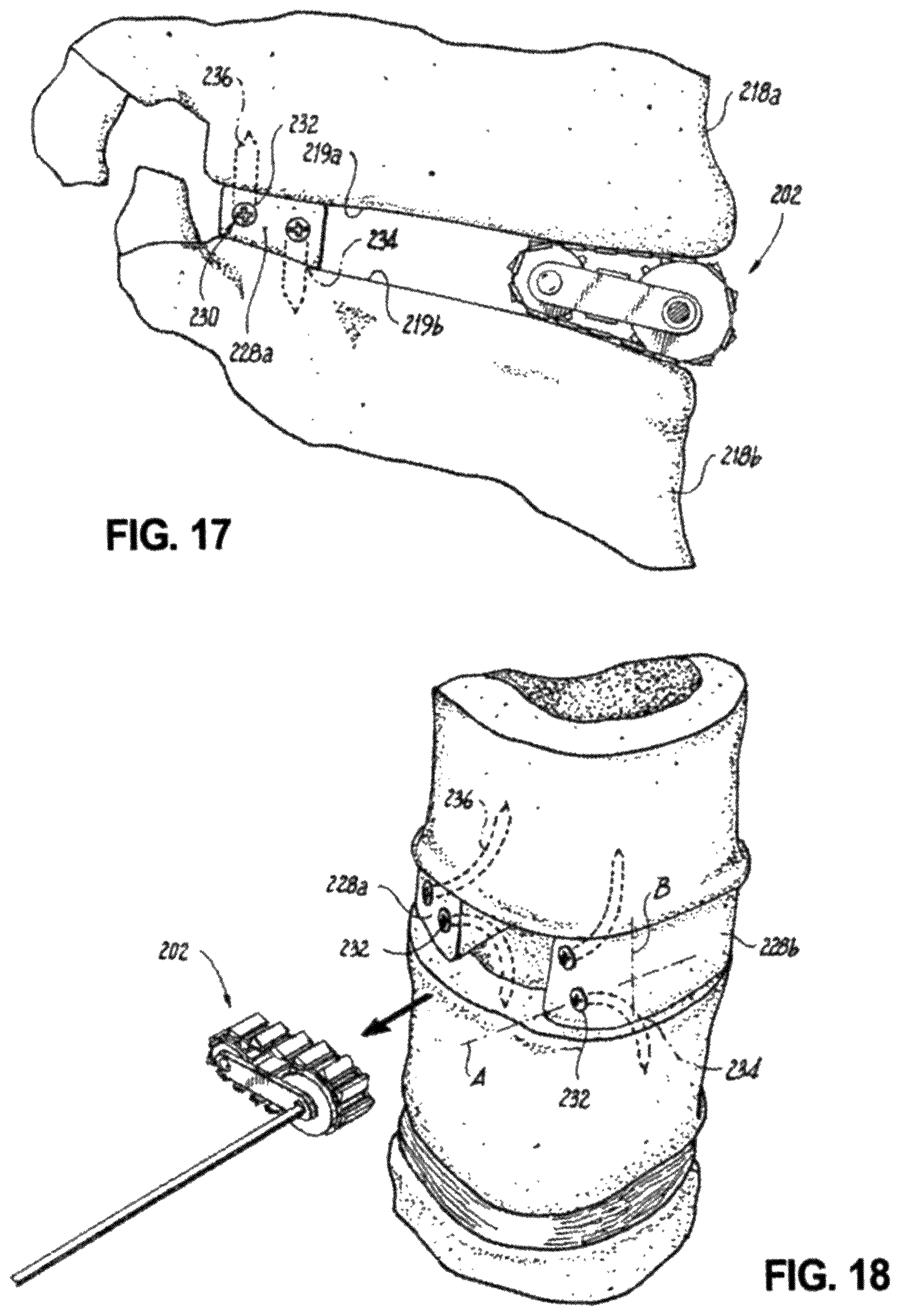 Patent US12496102 Figure 12 – Translational instrumentation for spondylolisthesis and scoliosis reduction