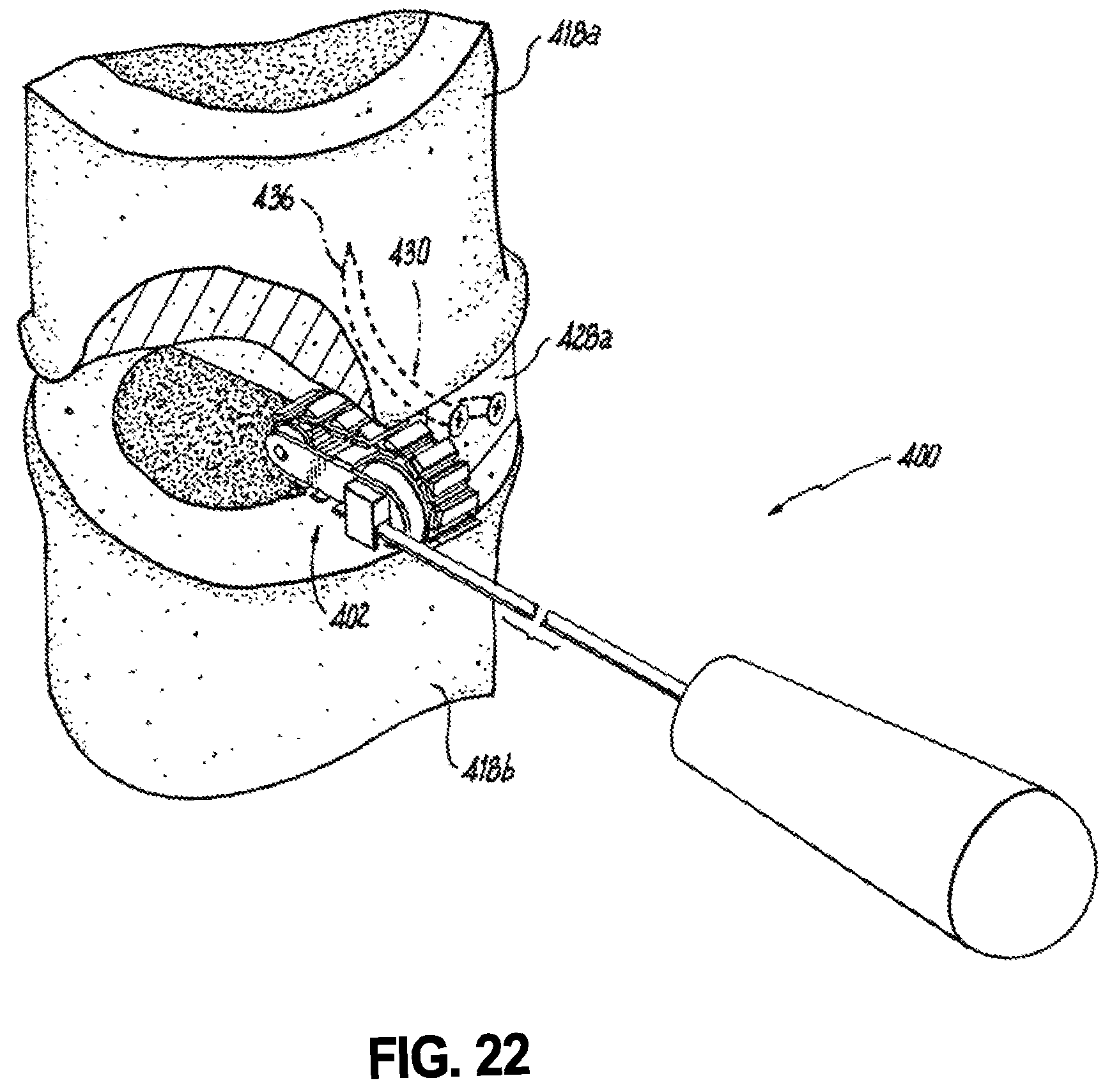 Patent US12496102 Figure 14 – Translational instrumentation for spondylolisthesis and scoliosis reduction