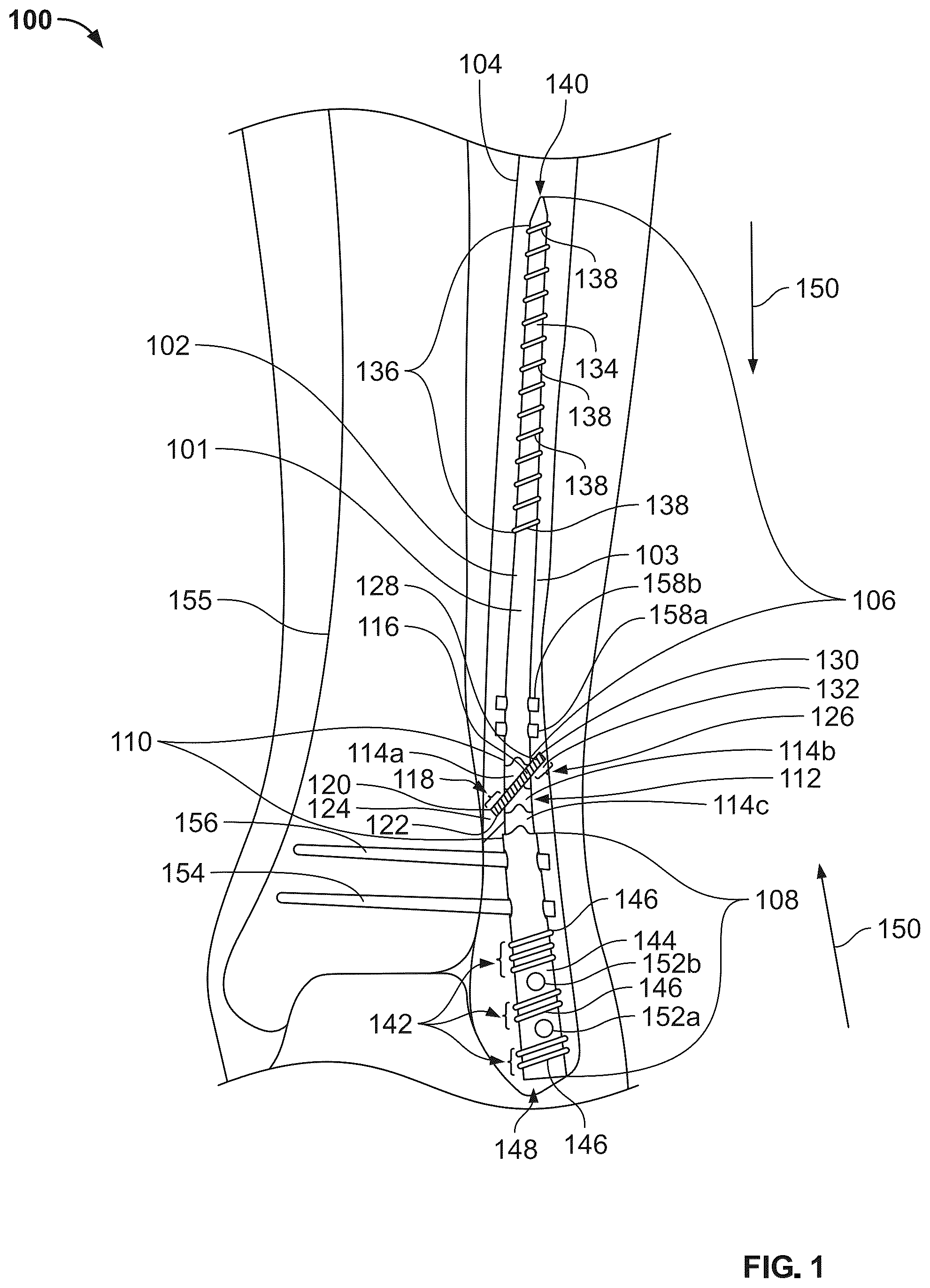 Patent US12496104 Figure 1 – Intramedullary bone fixation devices, systems, and methods
