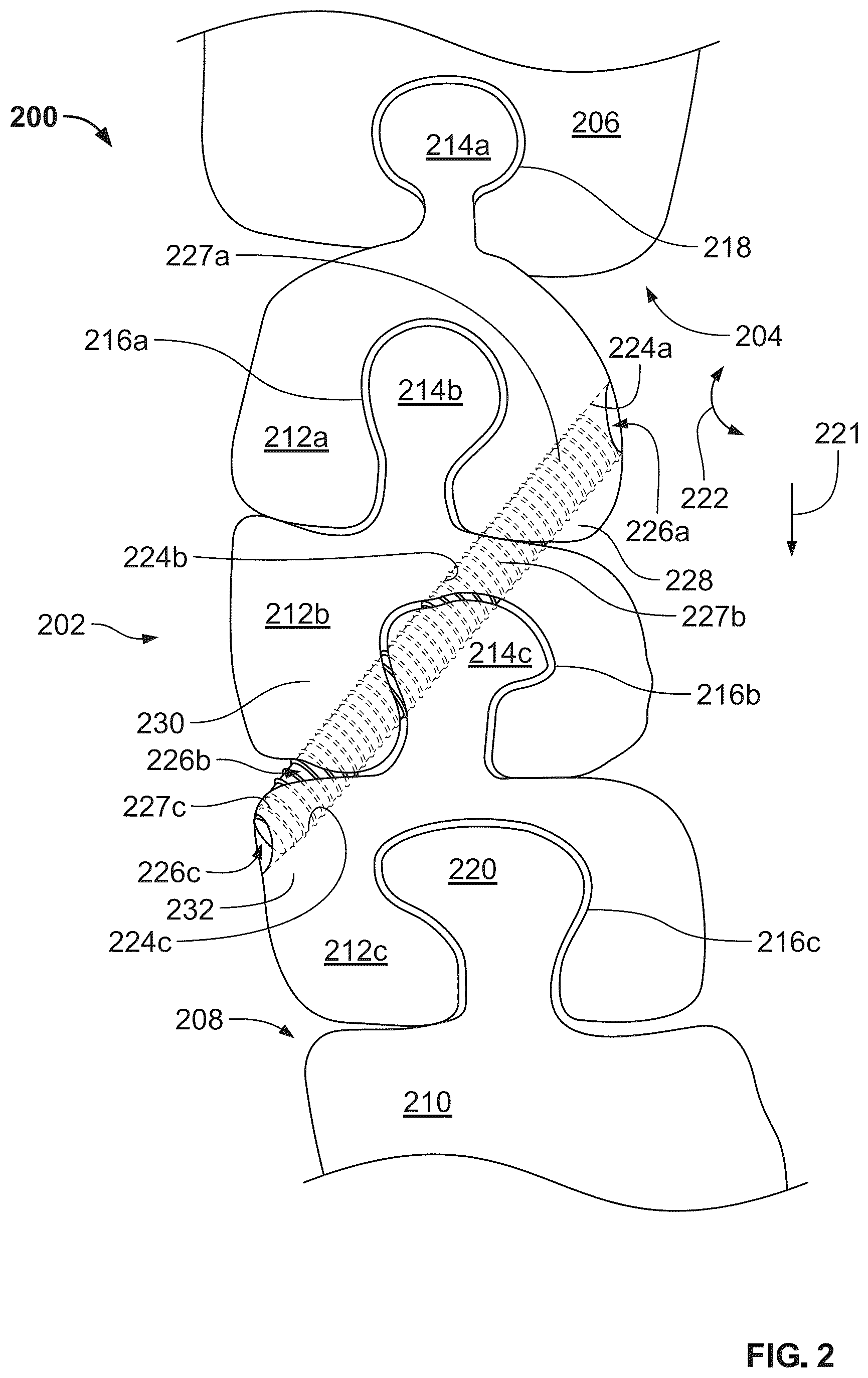 Patent US12496104 Figure 2 – Intramedullary bone fixation devices, systems, and methods