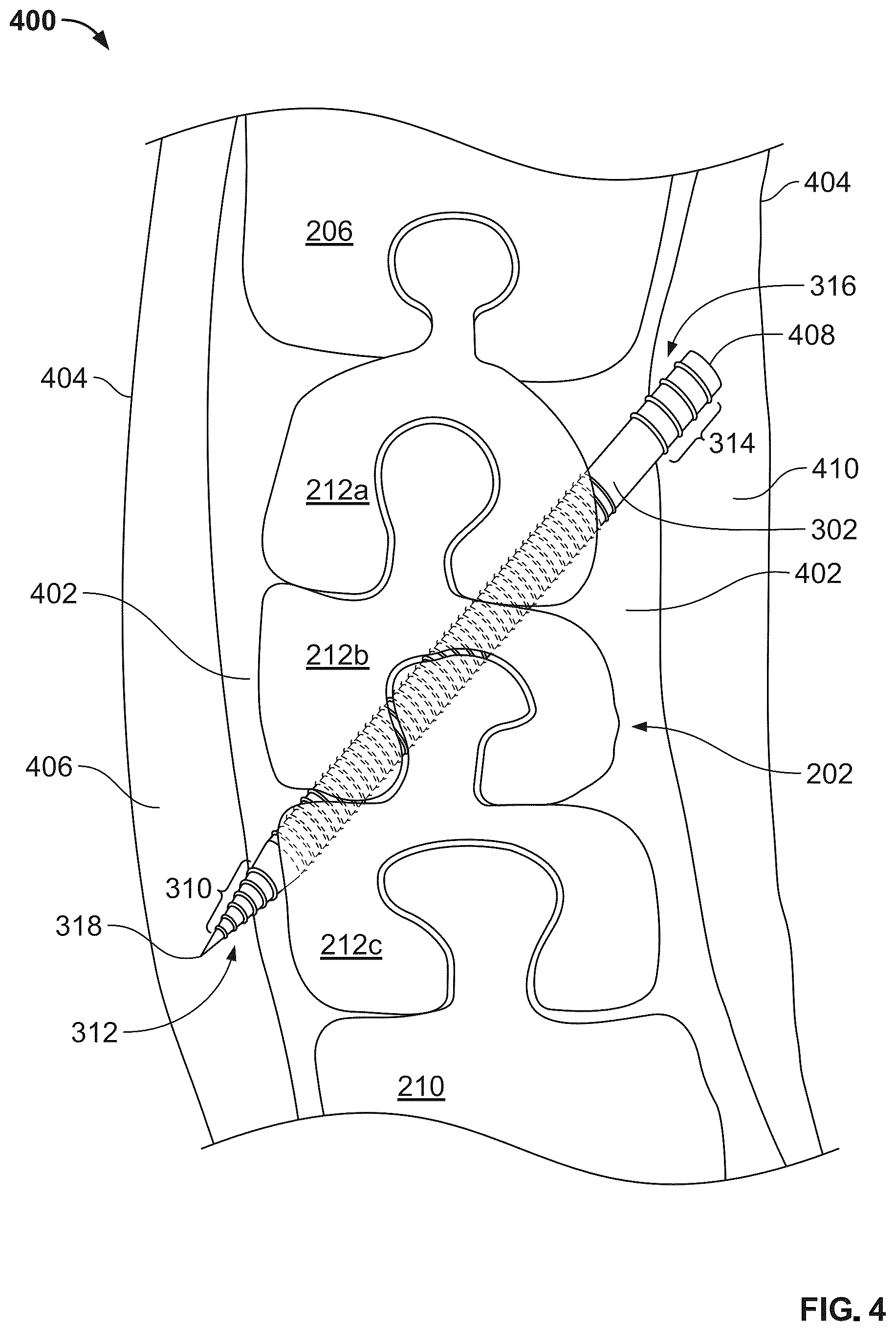 Patent US12496104 Figure 4 – Intramedullary bone fixation devices, systems, and methods