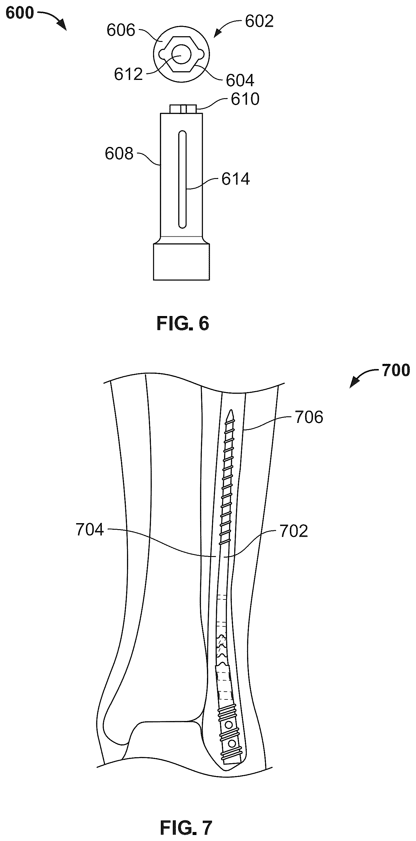 Patent US12496104 Figure 7 – Intramedullary bone fixation devices, systems, and methods