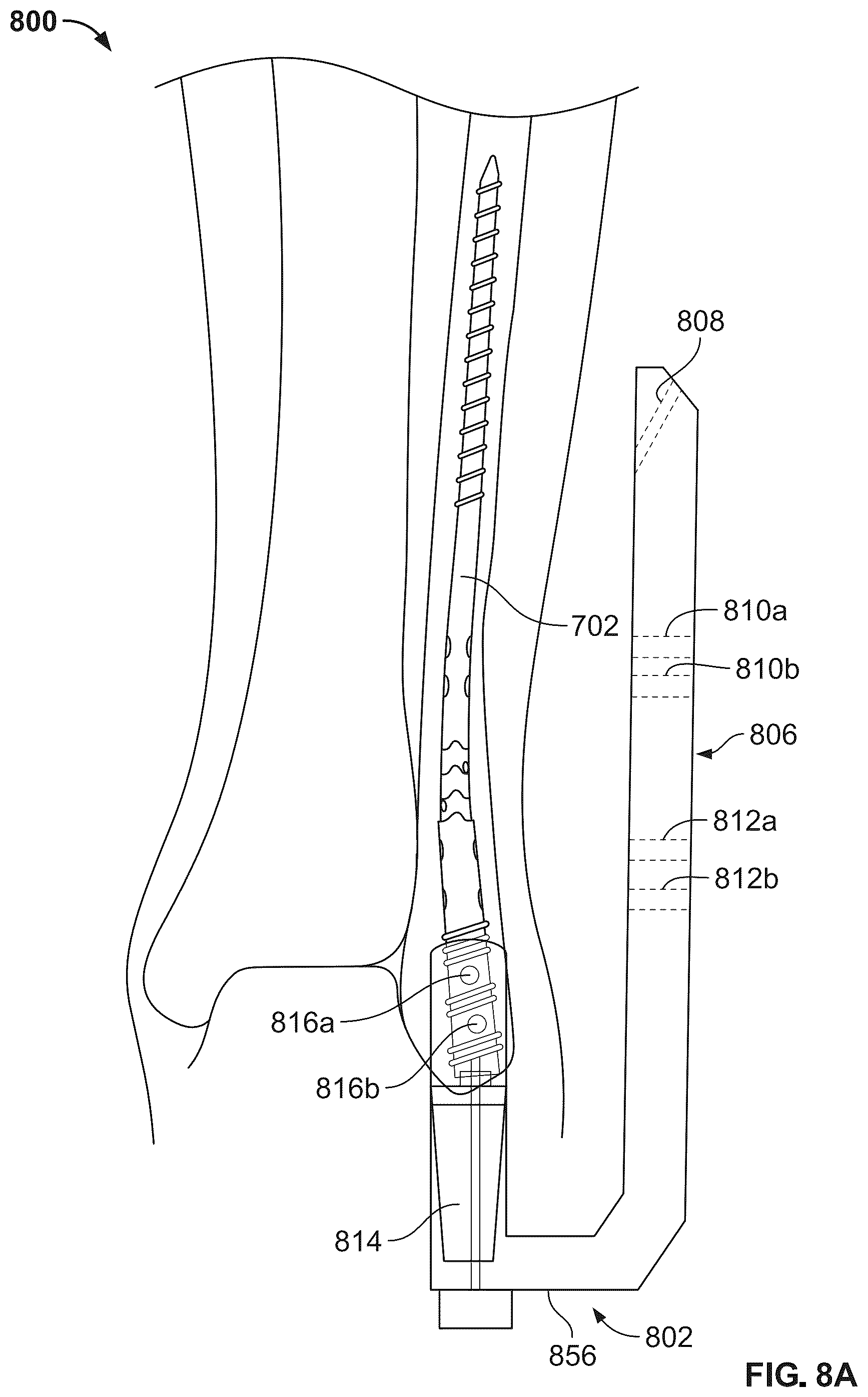 Patent US12496104 Figure 8 – Intramedullary bone fixation devices, systems, and methods