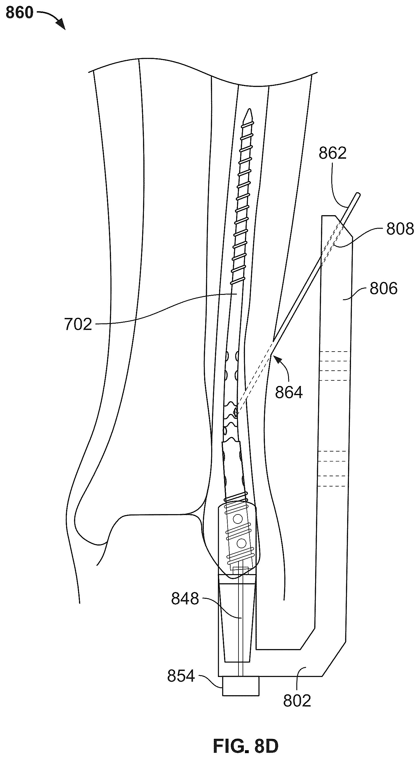 Patent US12496104 Figure 10 – Intramedullary bone fixation devices, systems, and methods