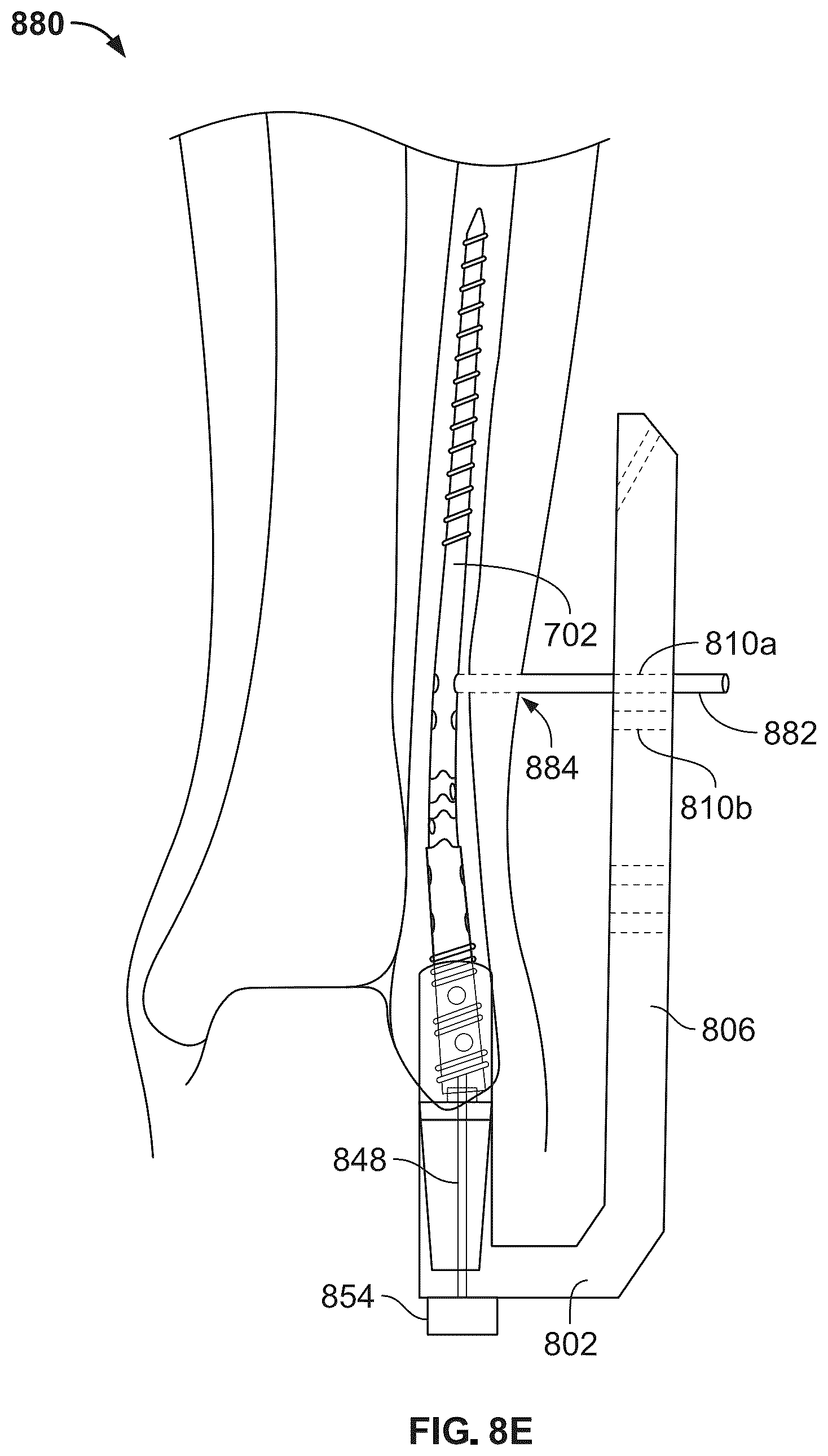 Patent US12496104 Figure 11 – Intramedullary bone fixation devices, systems, and methods