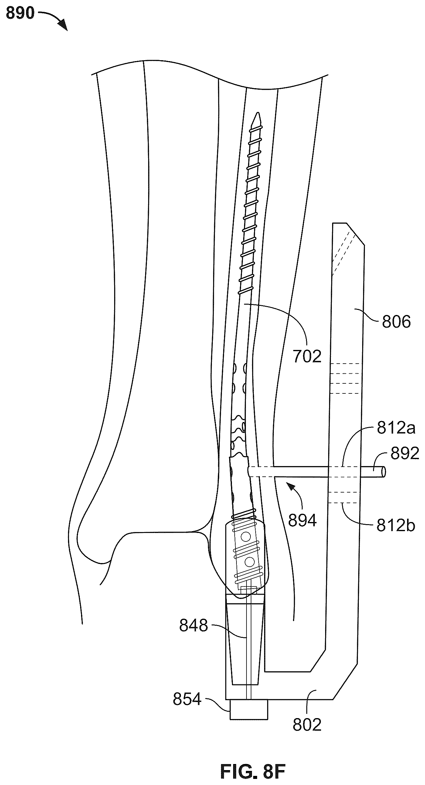 Patent US12496104 Figure 12 – Intramedullary bone fixation devices, systems, and methods
