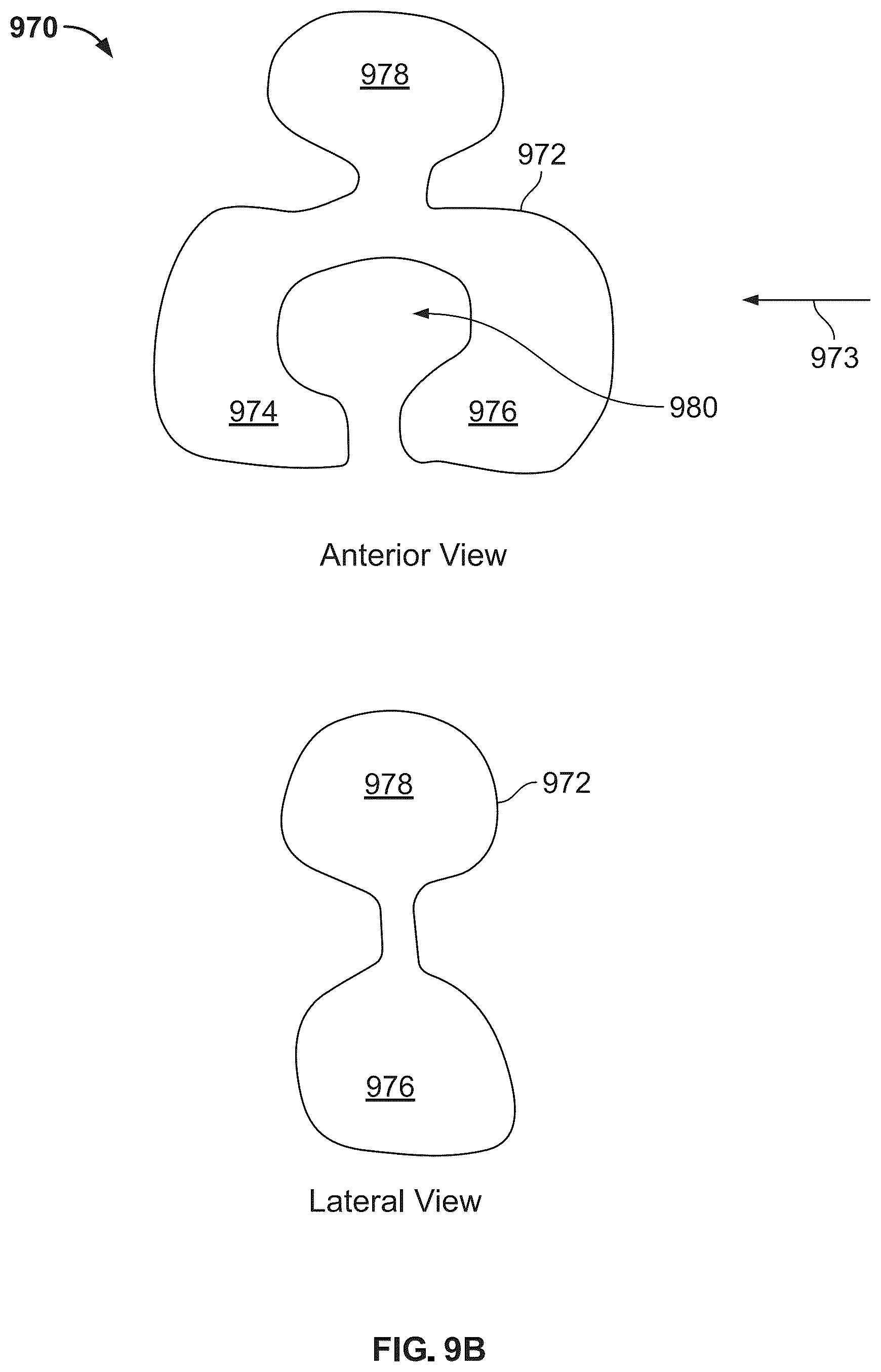 Patent US12496104 Figure 14 – Intramedullary bone fixation devices, systems, and methods
