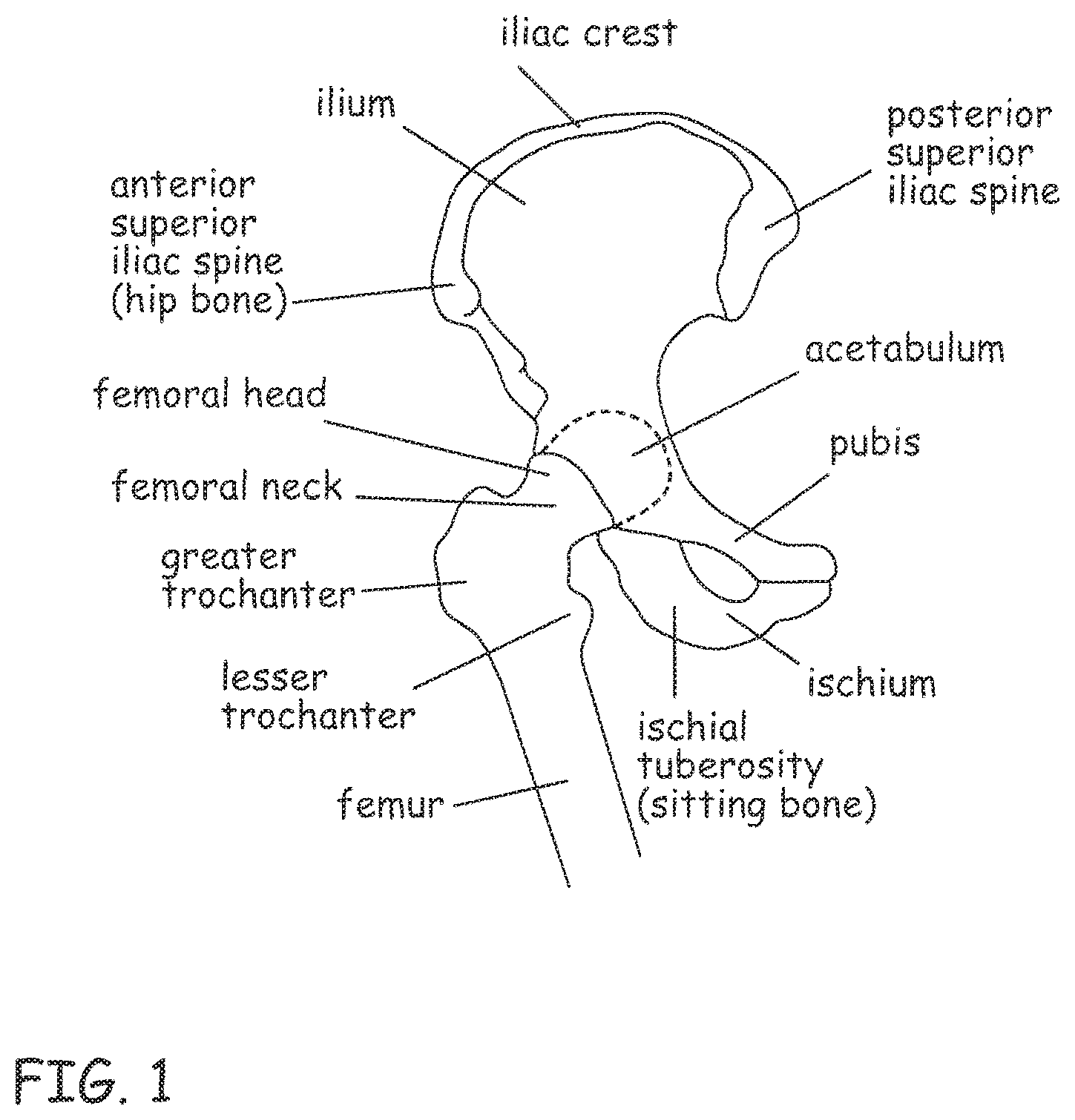 Patent US12496106 Figure 1 – Devices, methods and systems for remedying or preventing fractures